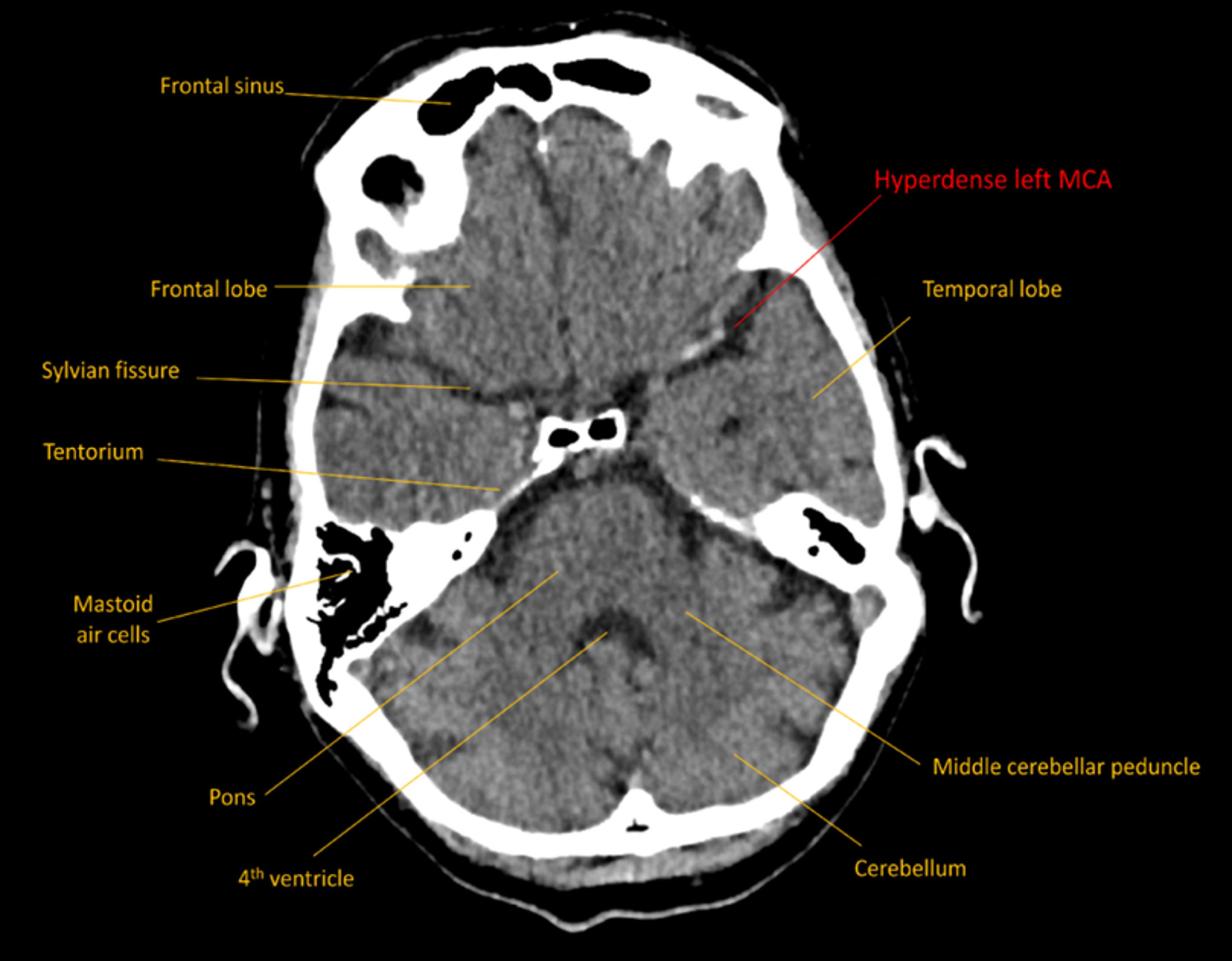 Hyperdense MCA on CT