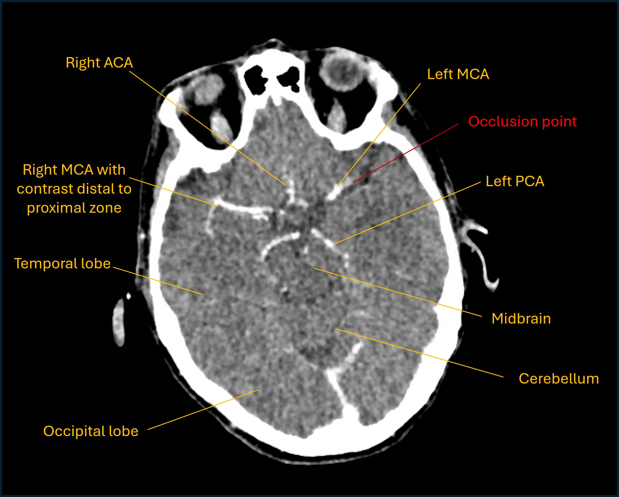 CT angiogram