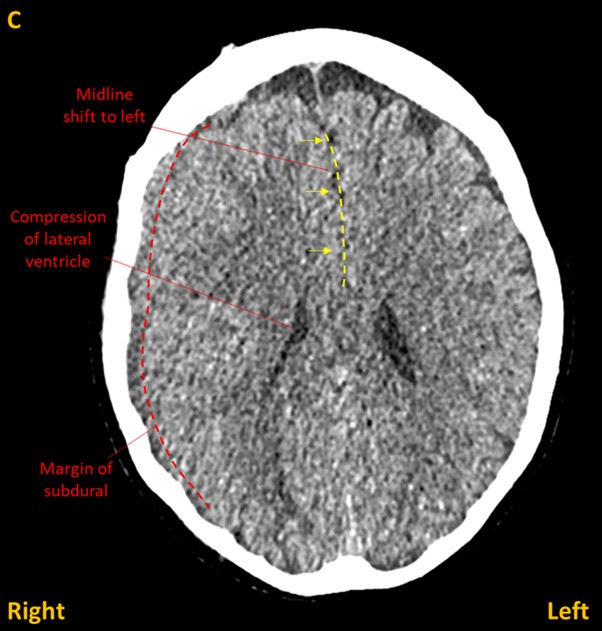 CT 3