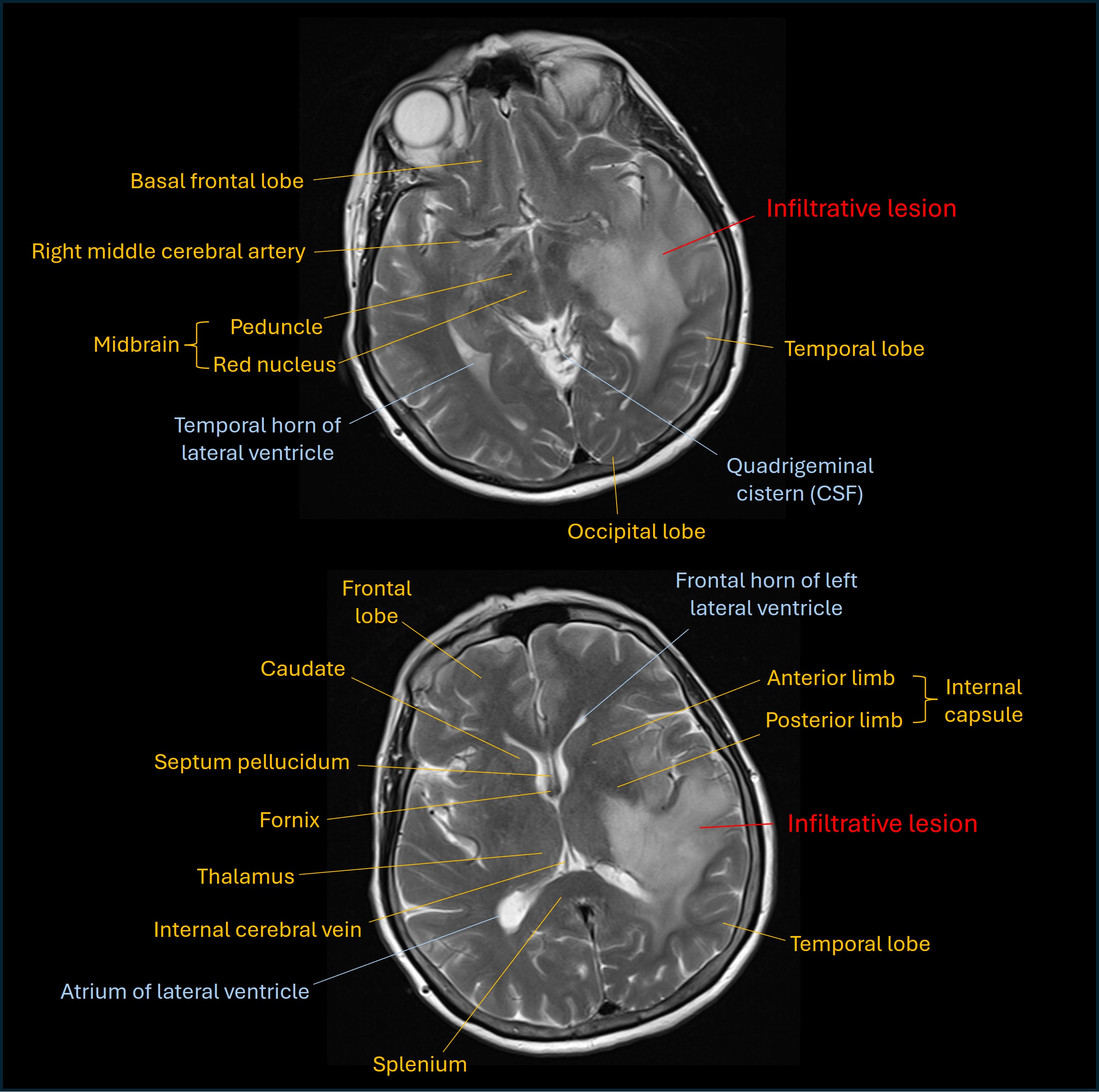 T2 MRI