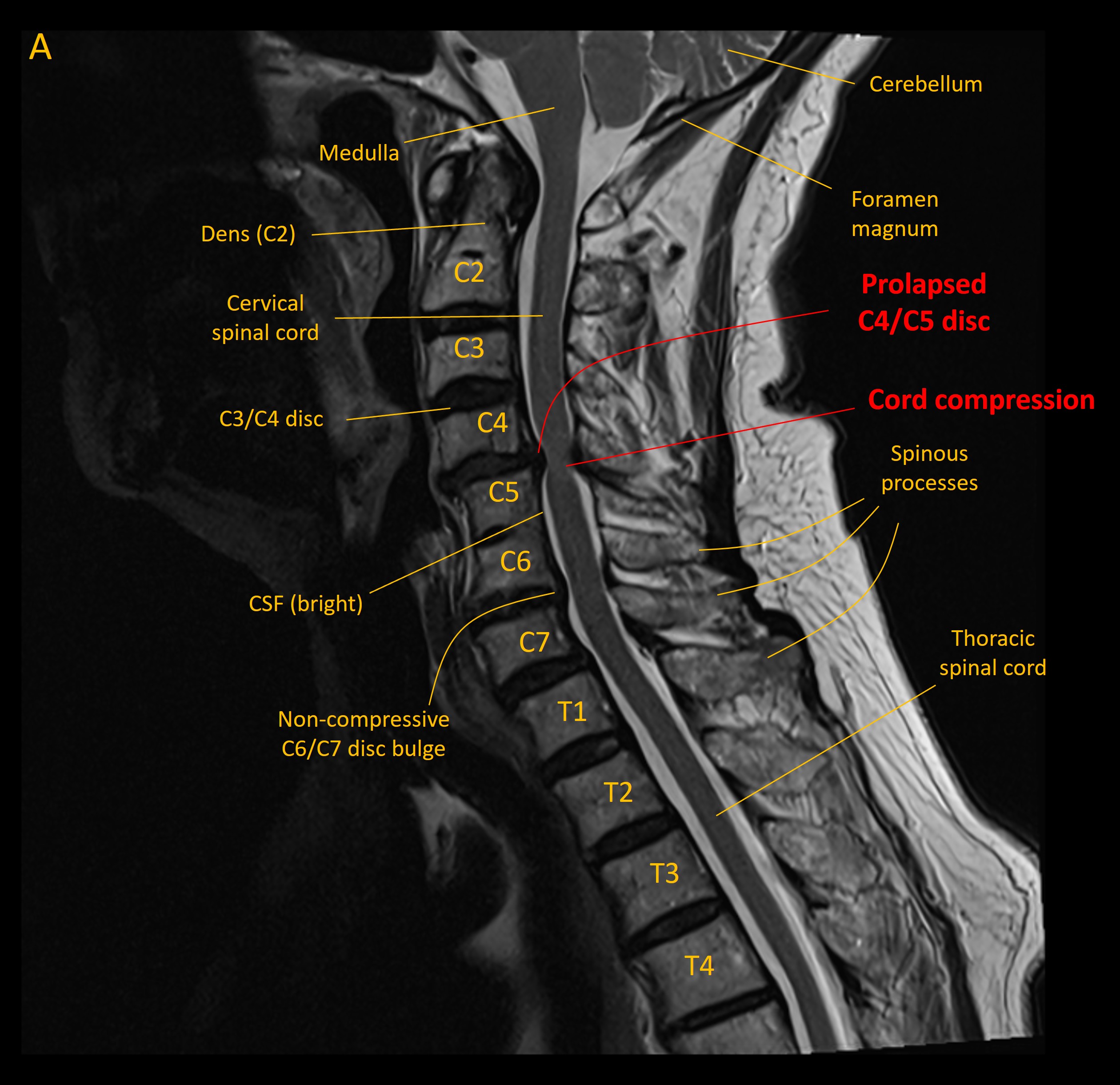 Sagittal MRI
