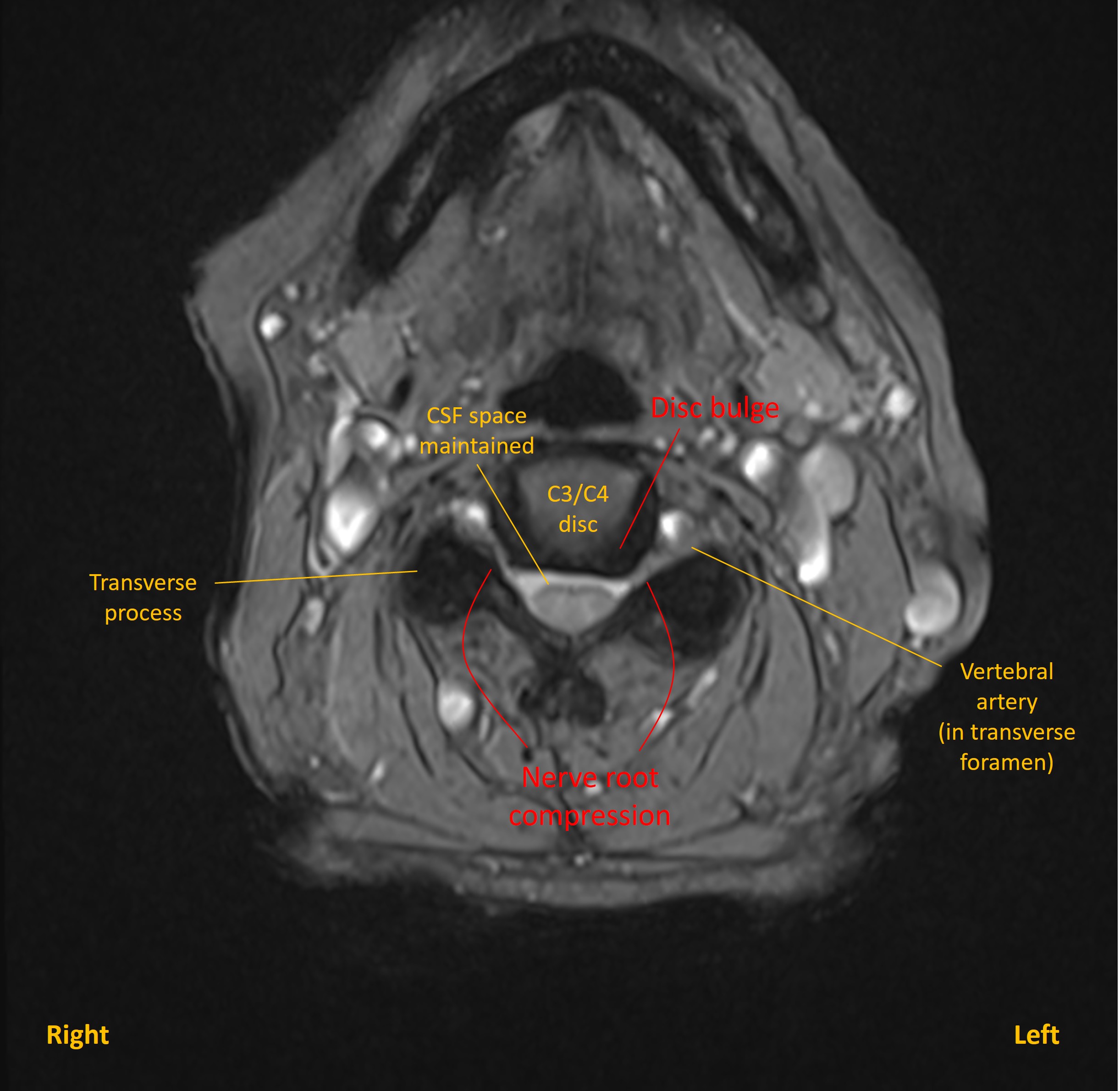 Axial MRI