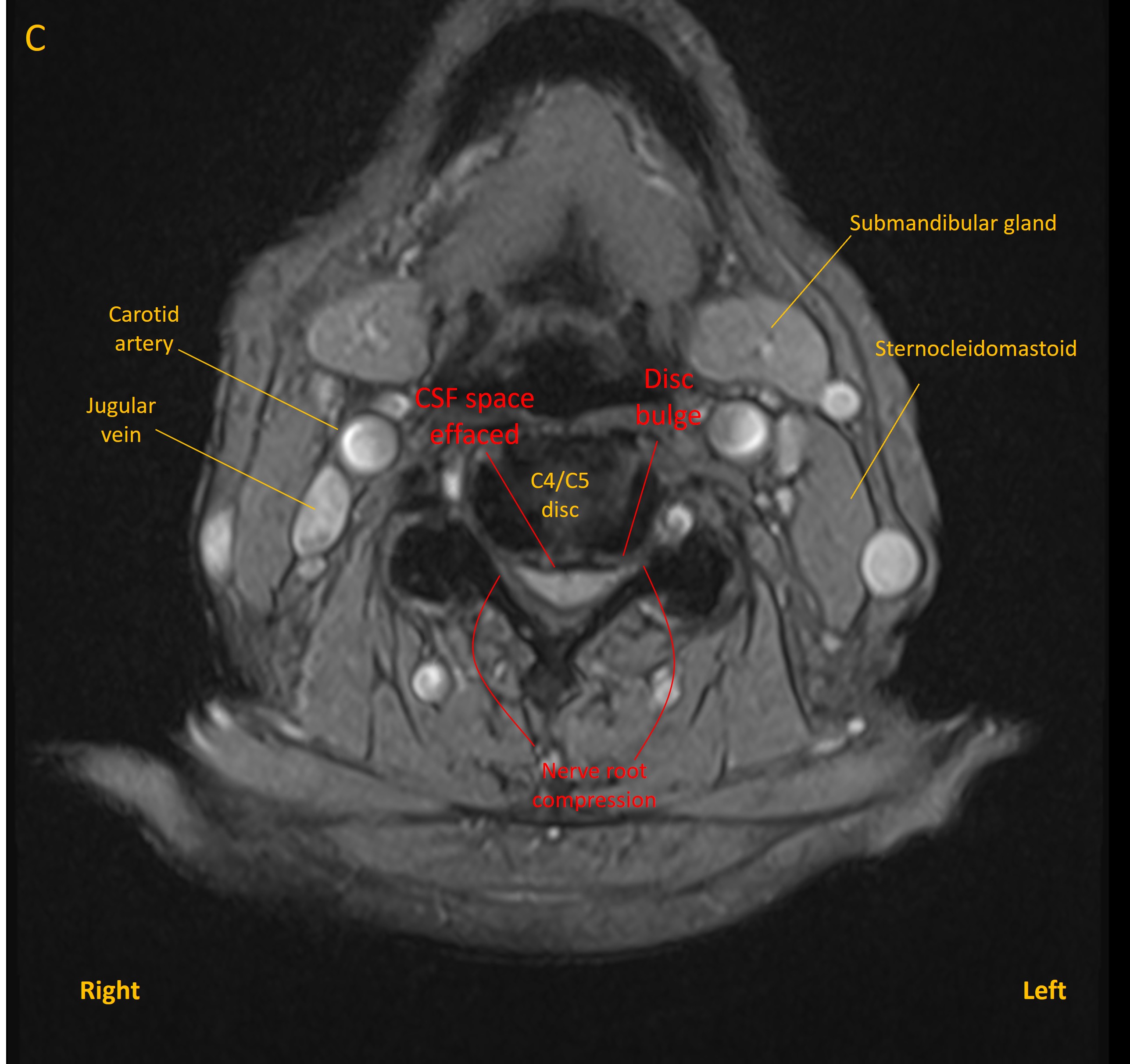 Axial MRI