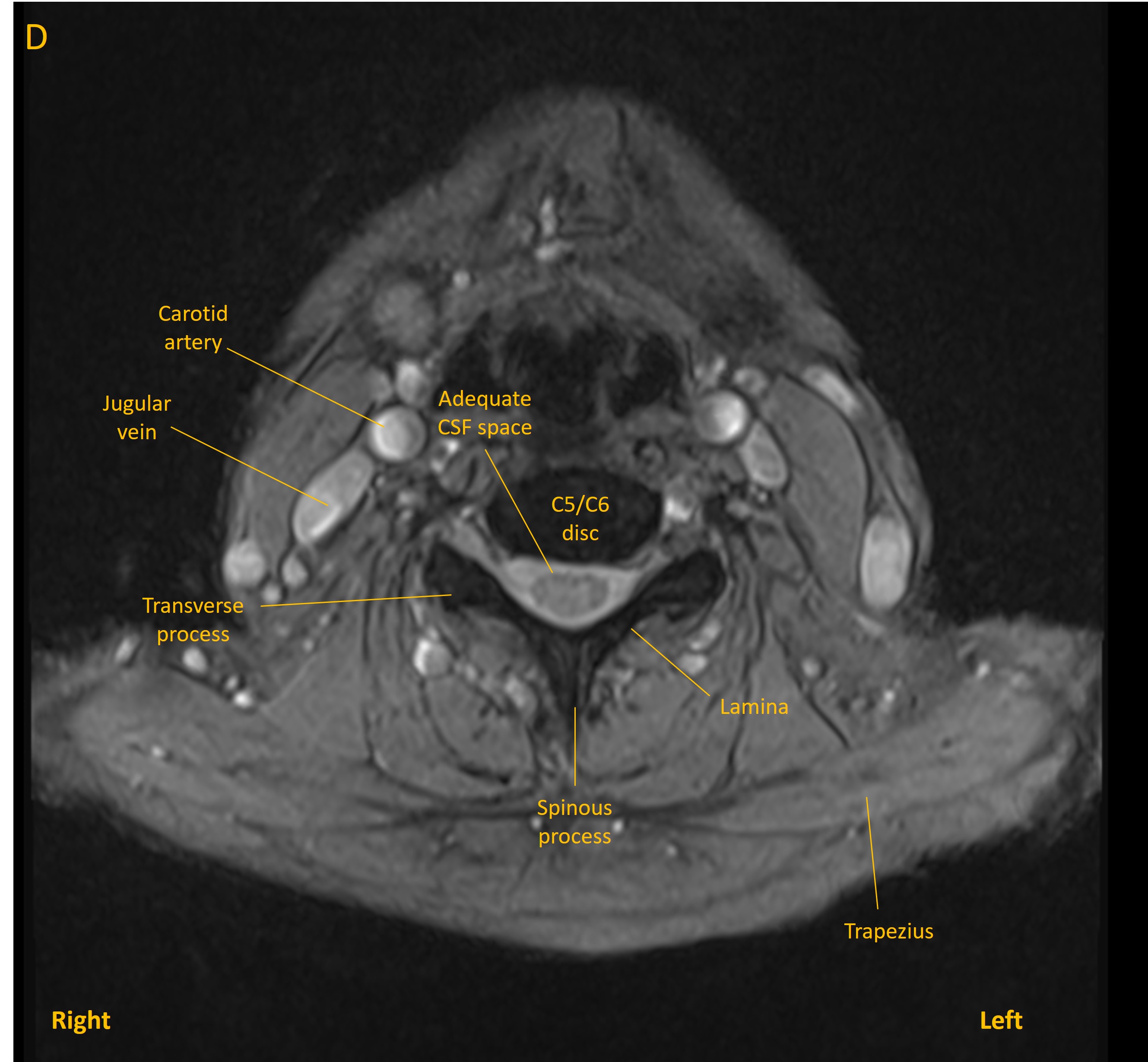 Axial MRI