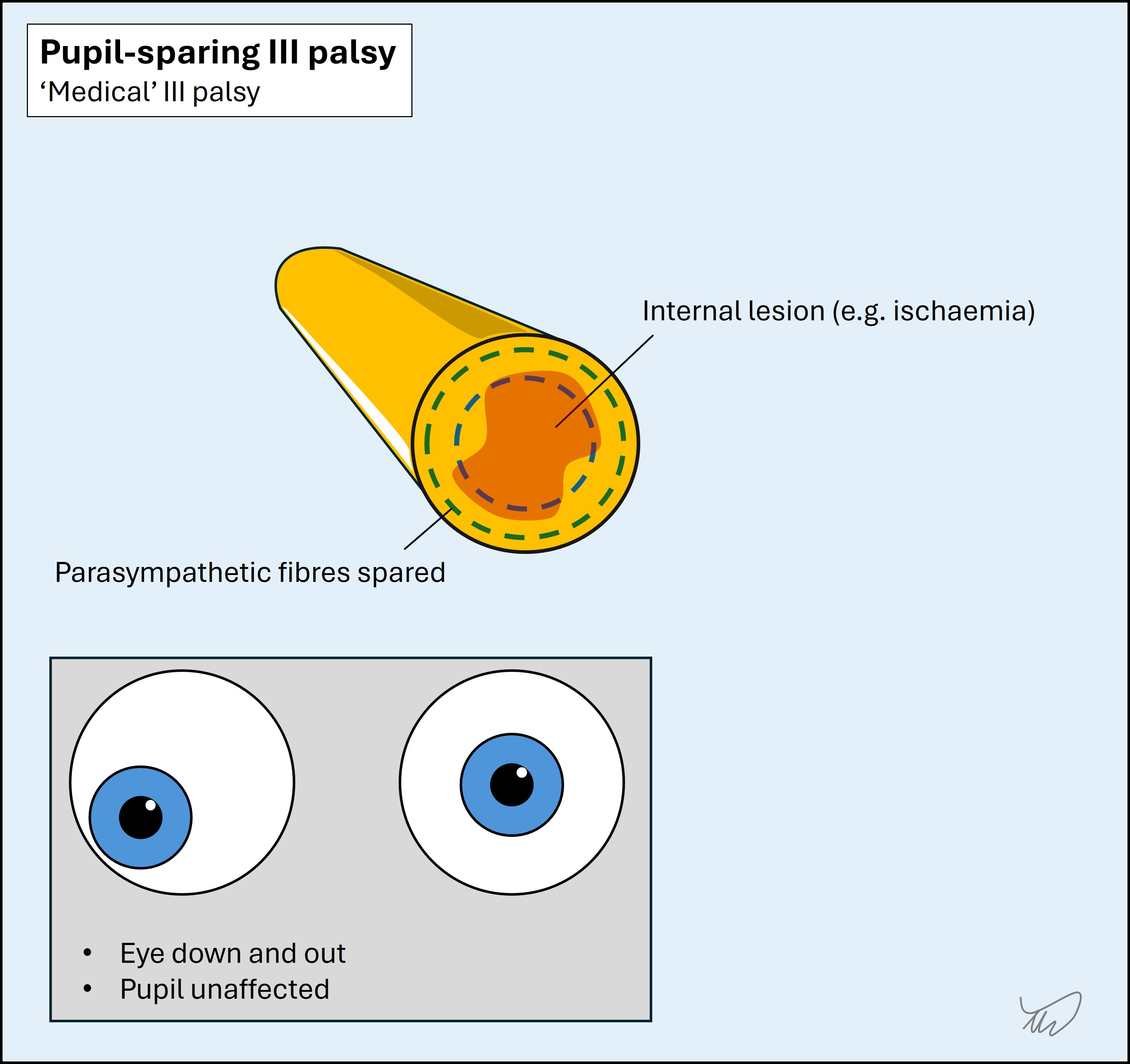 Pupil sparing III palsy