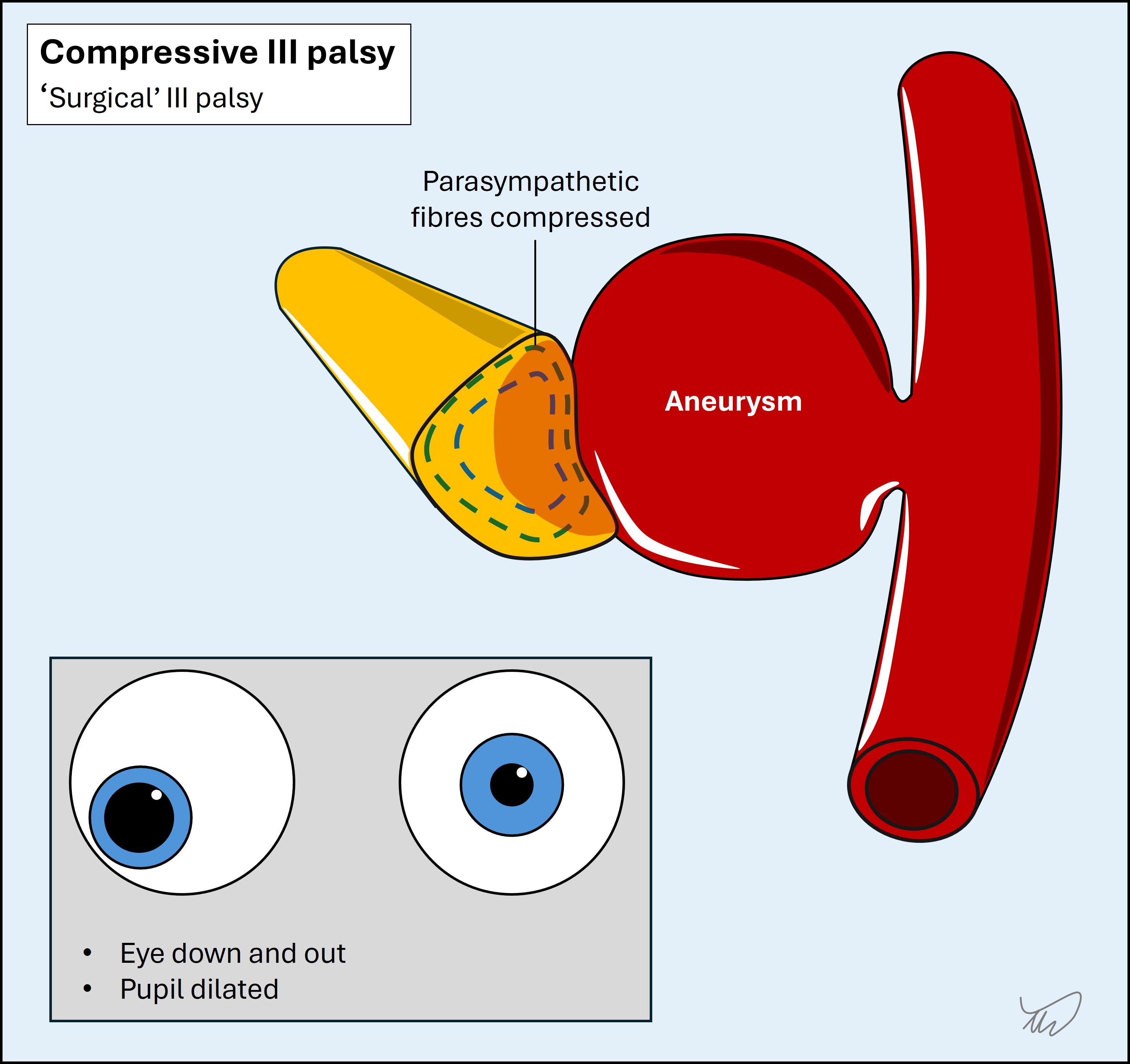 Surgical III palsy