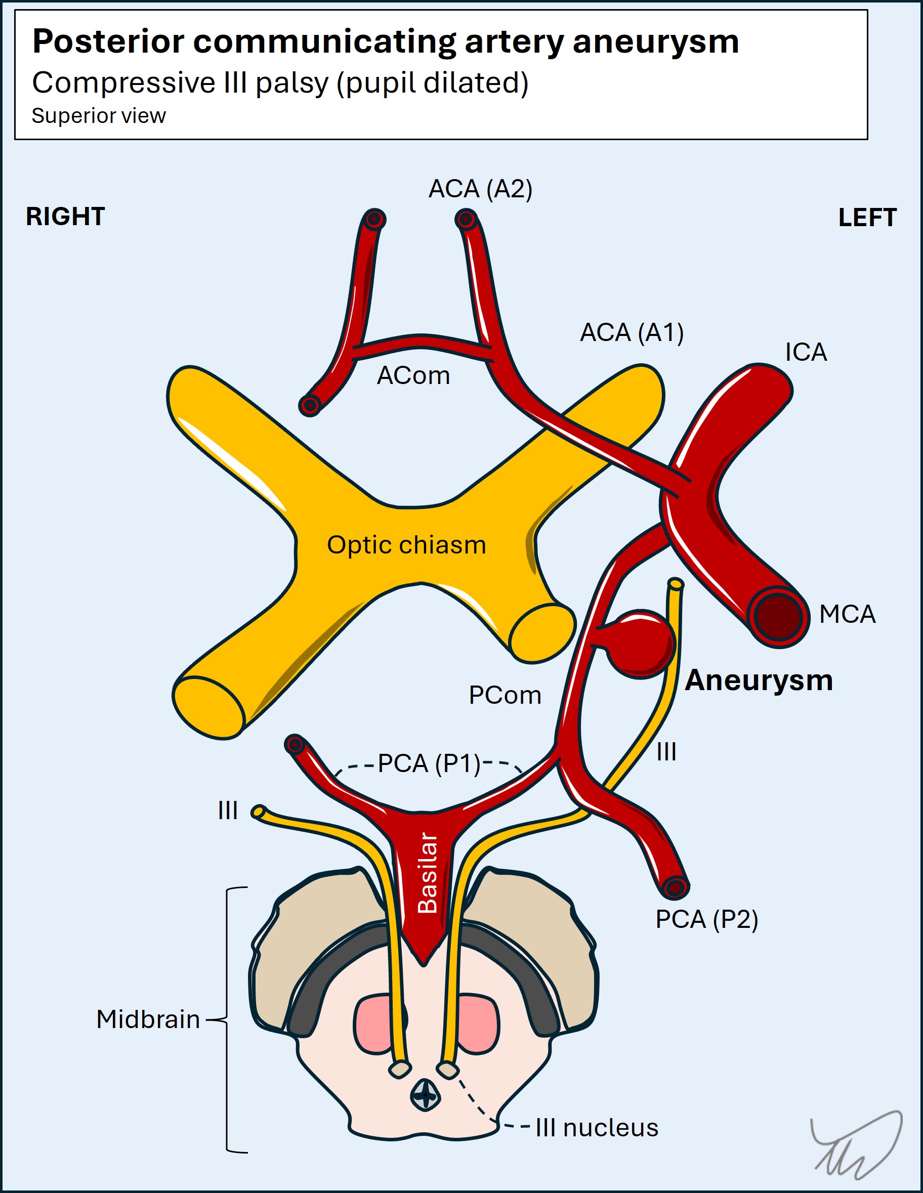 PCom aneurysm