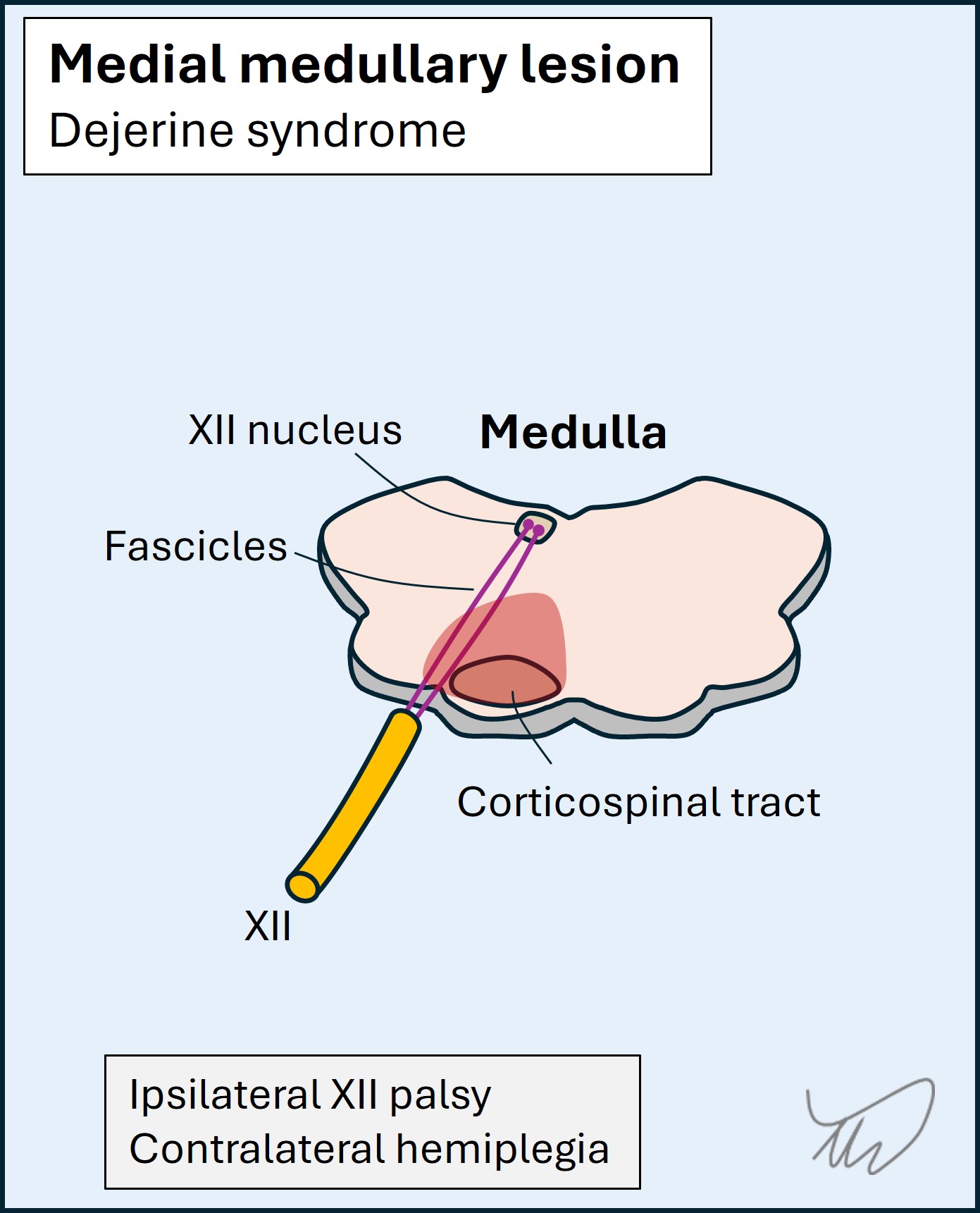 Dejerine syndrome