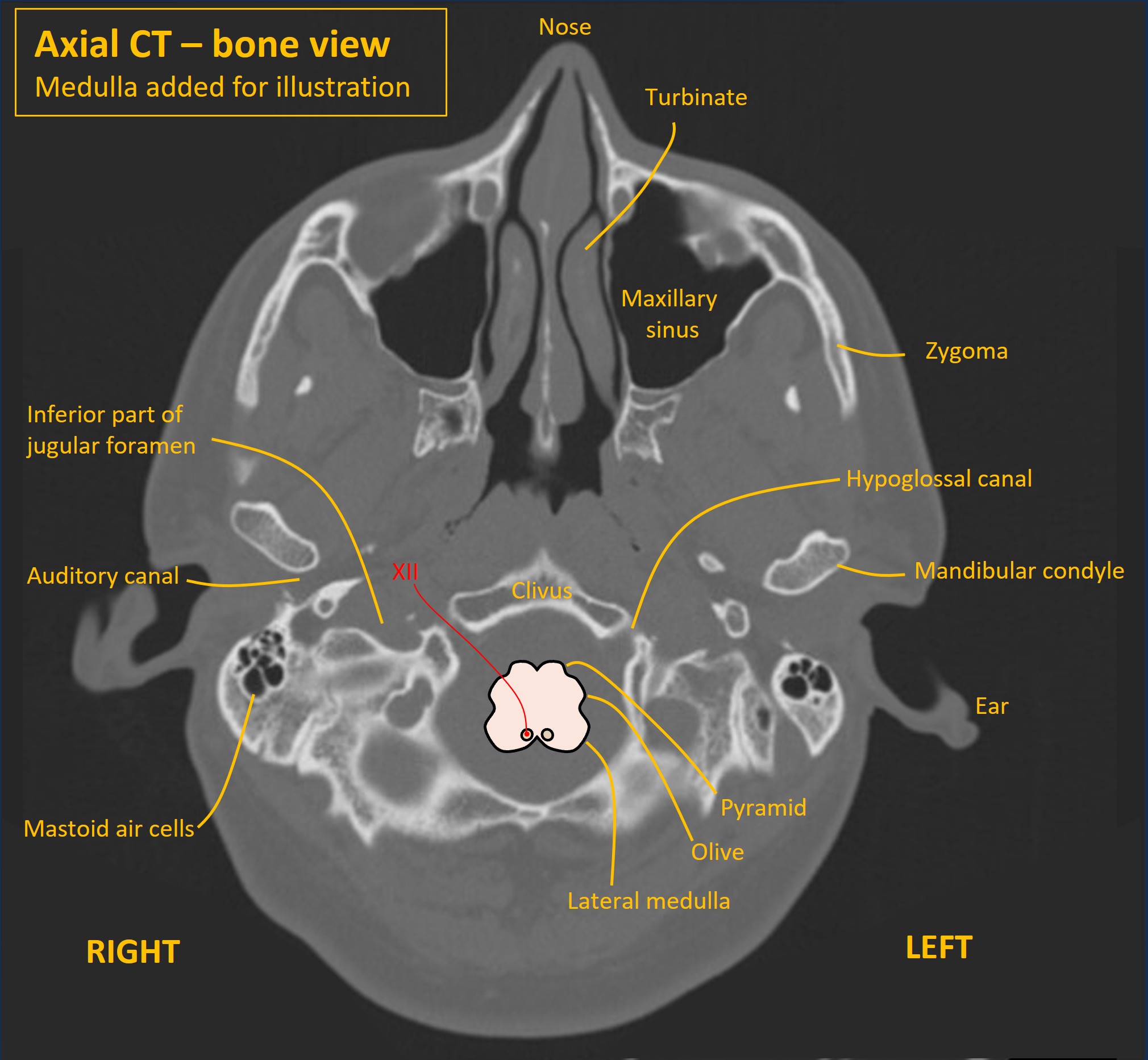 XII within skull