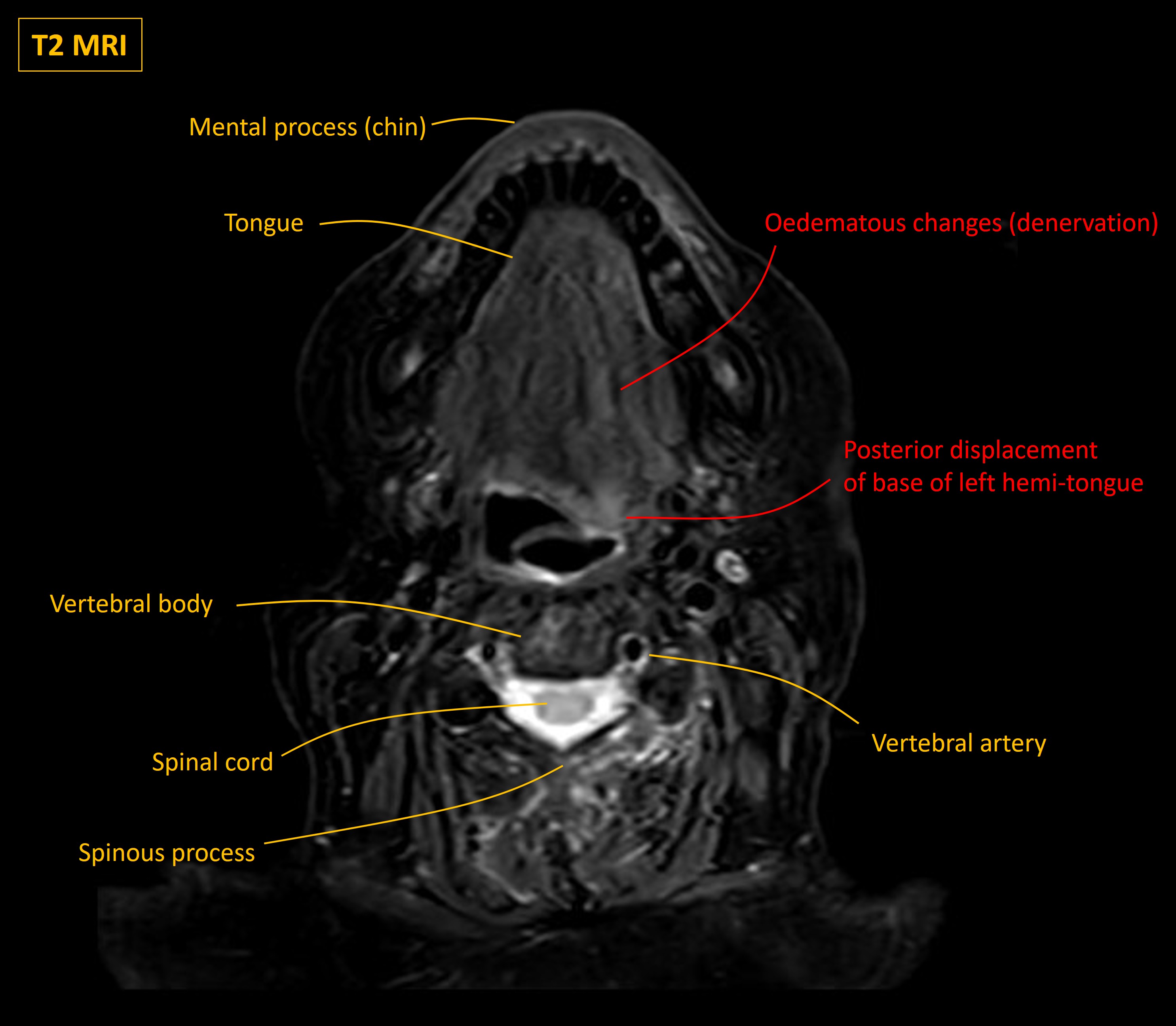 Hypoglossal