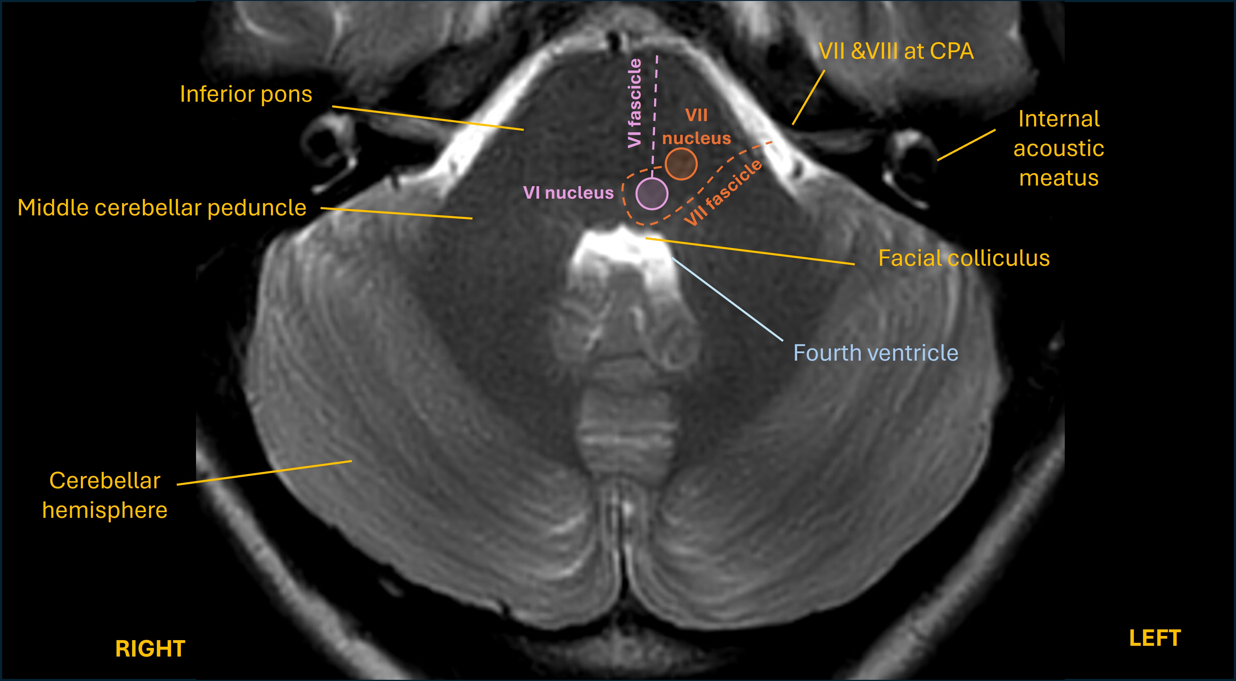 Facial colliculus