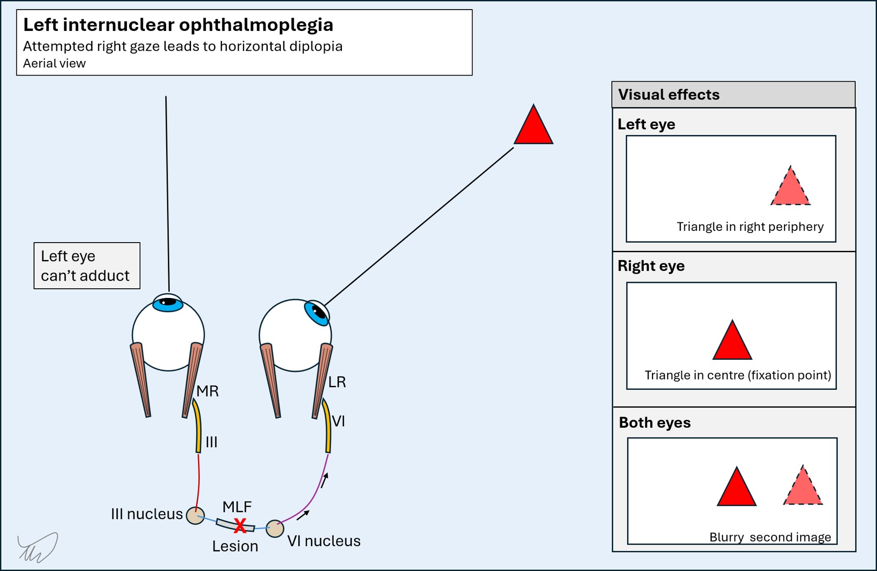 INO diplopia