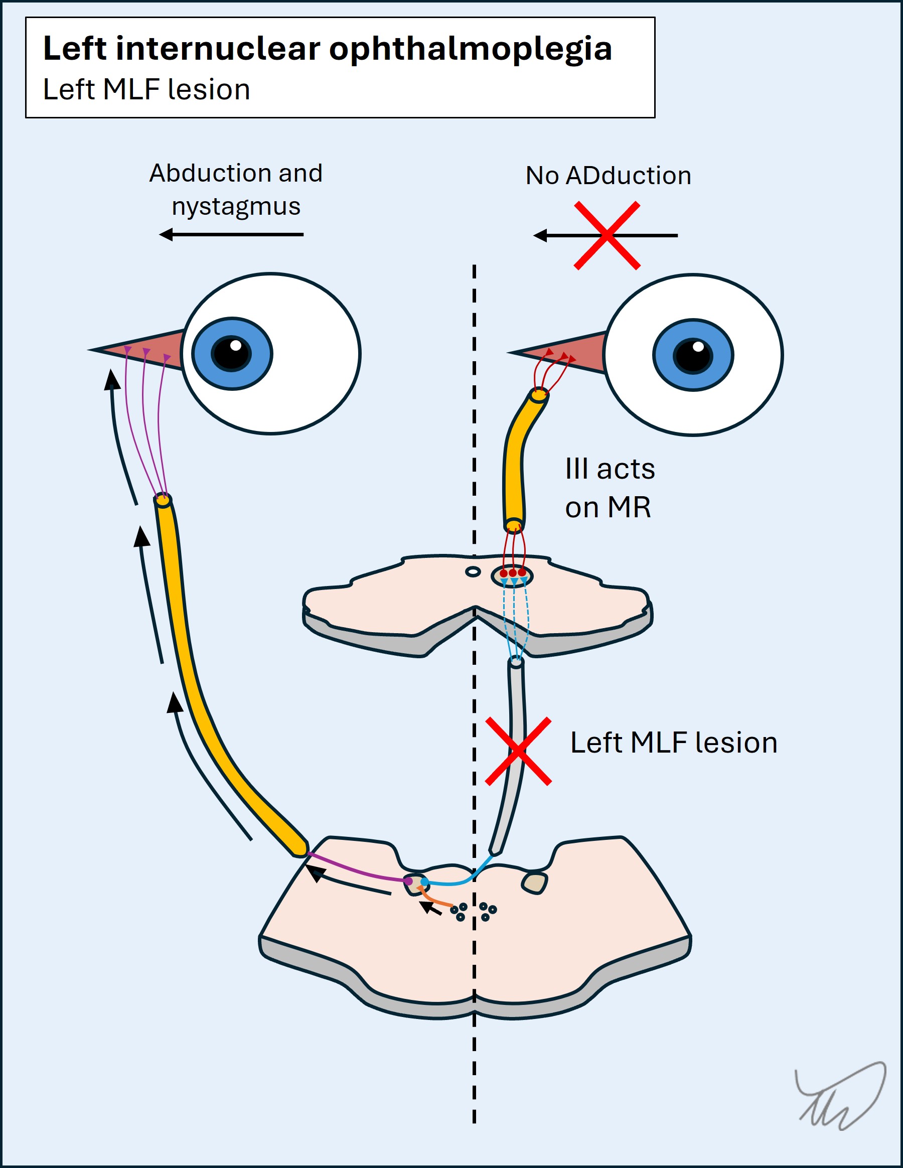 Internuclear ophthalmoplegia