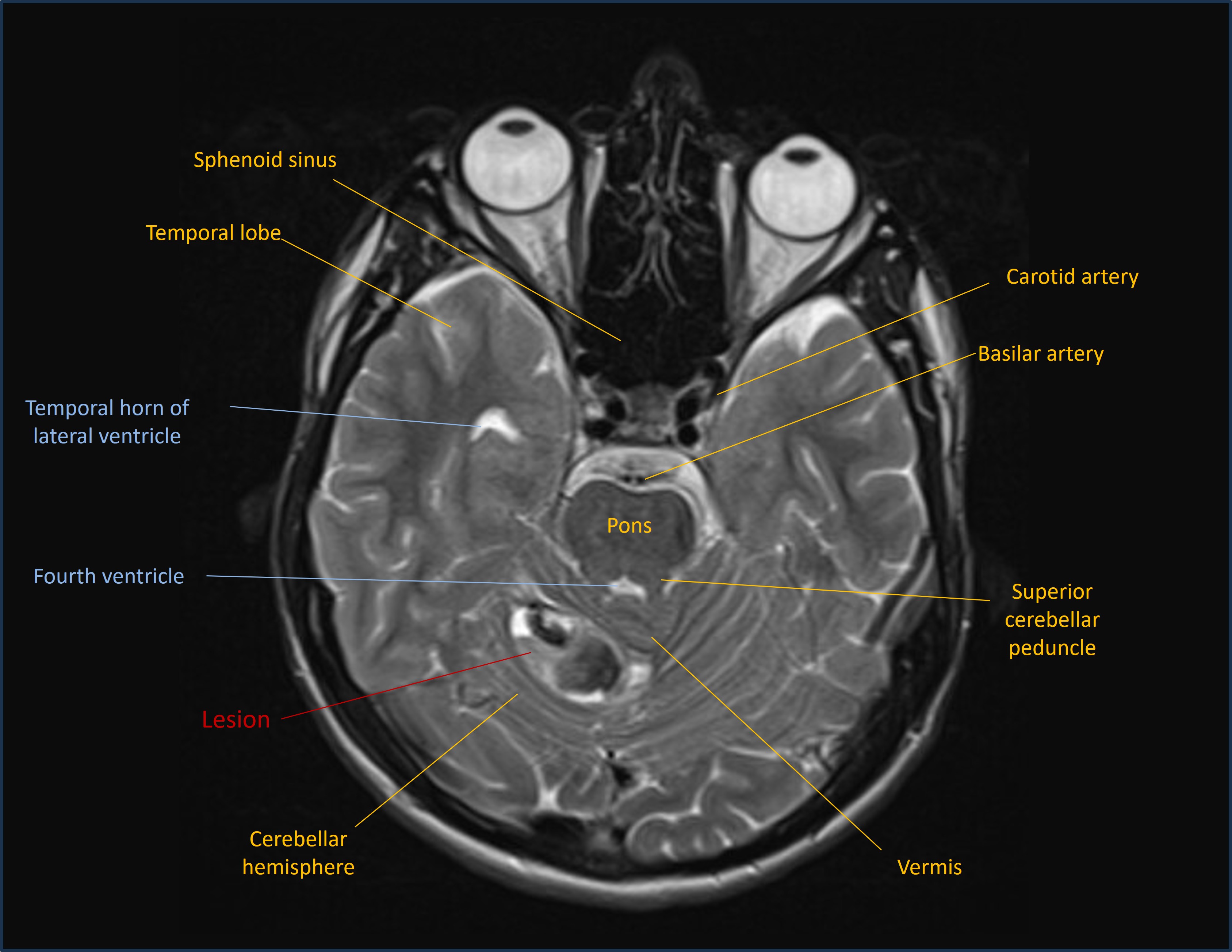 Axial MRI