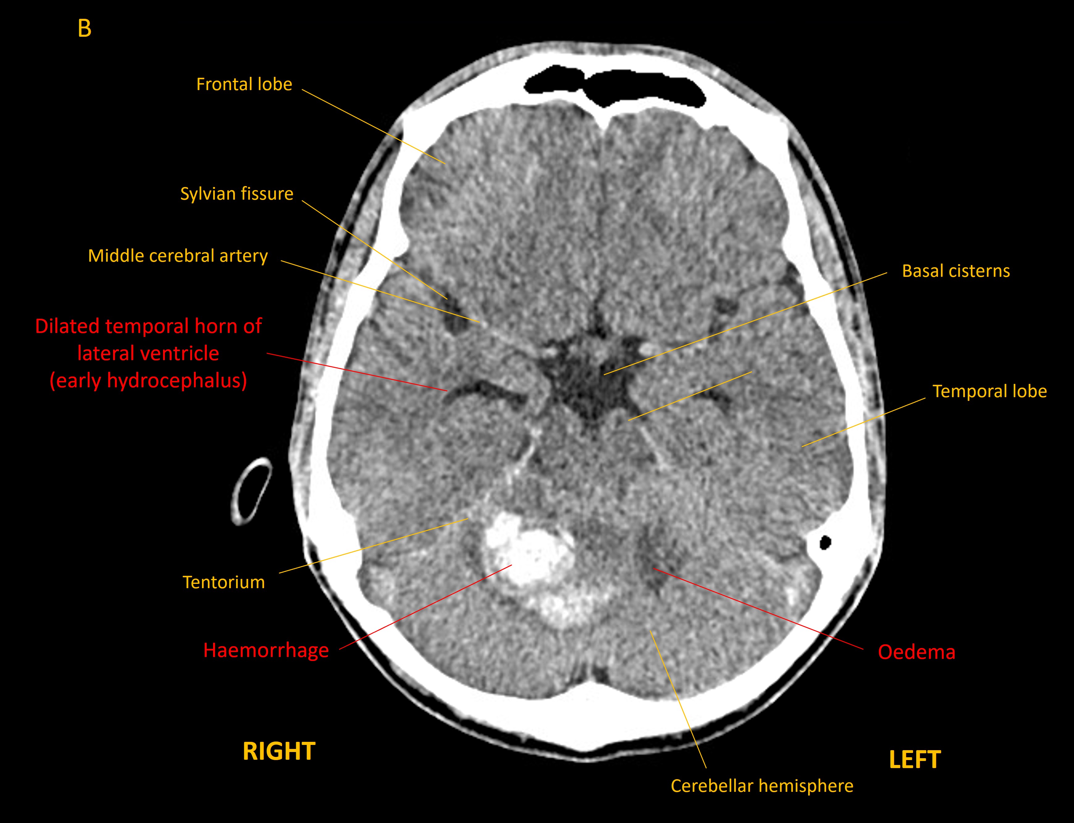 Axial CT brain