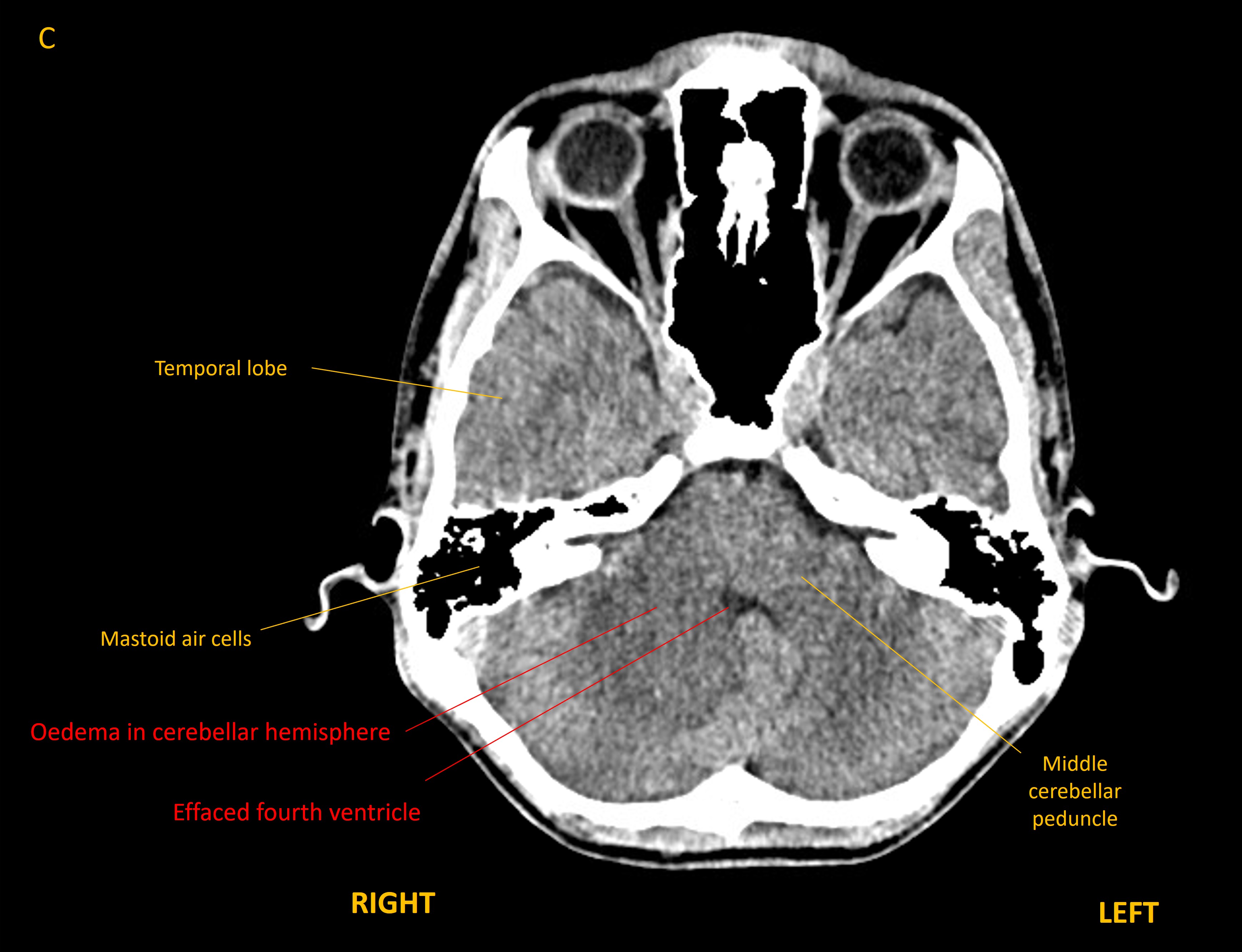 Axial CT brain