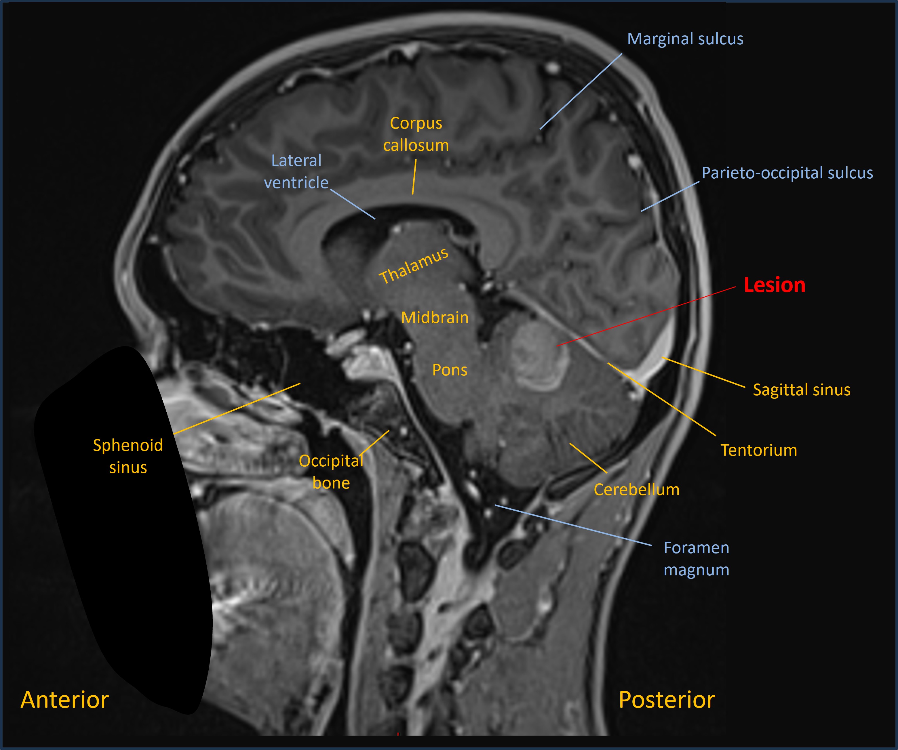 Sagittal MRI