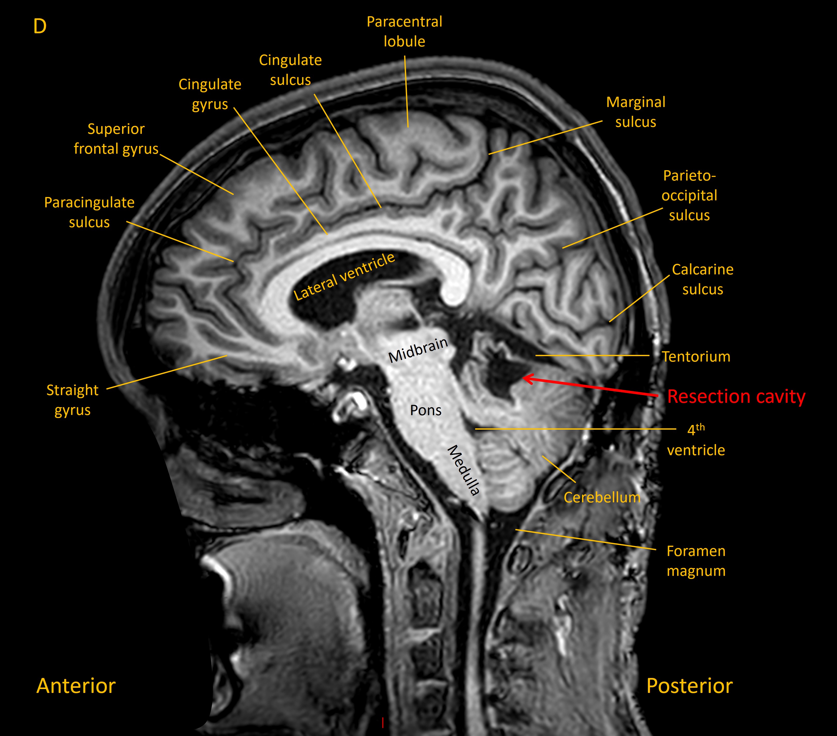 Sagittal MRI