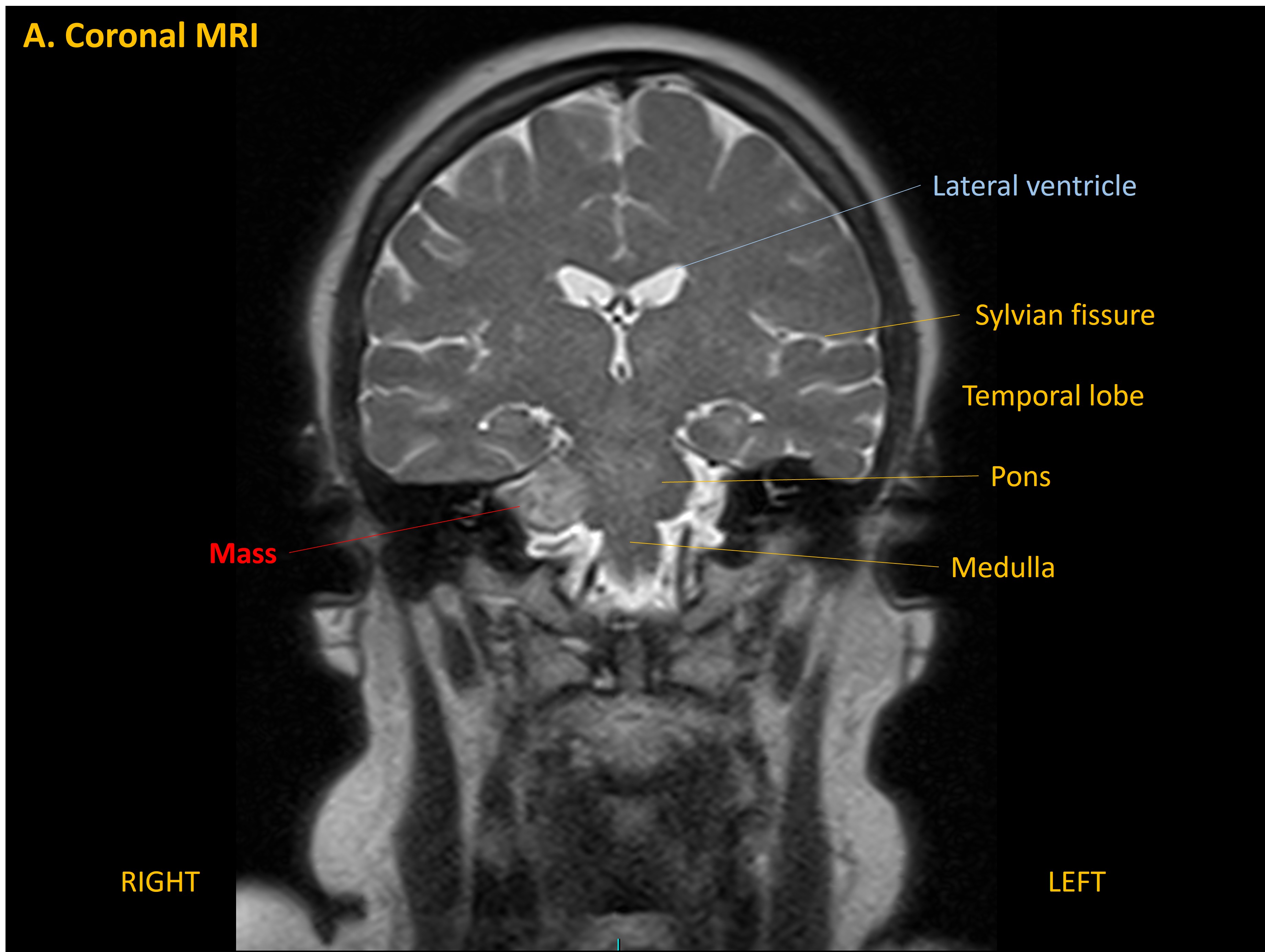 MRI1