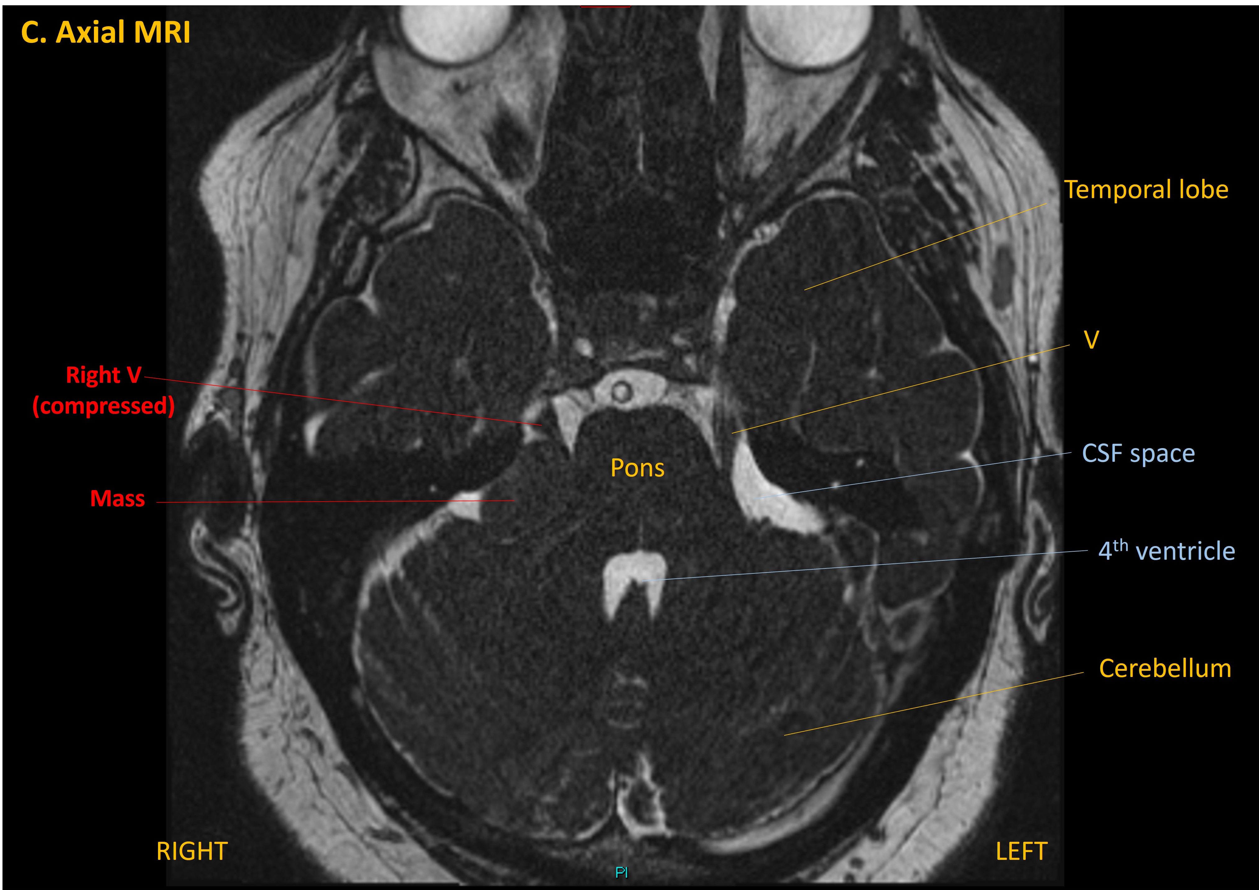 Trigeminal