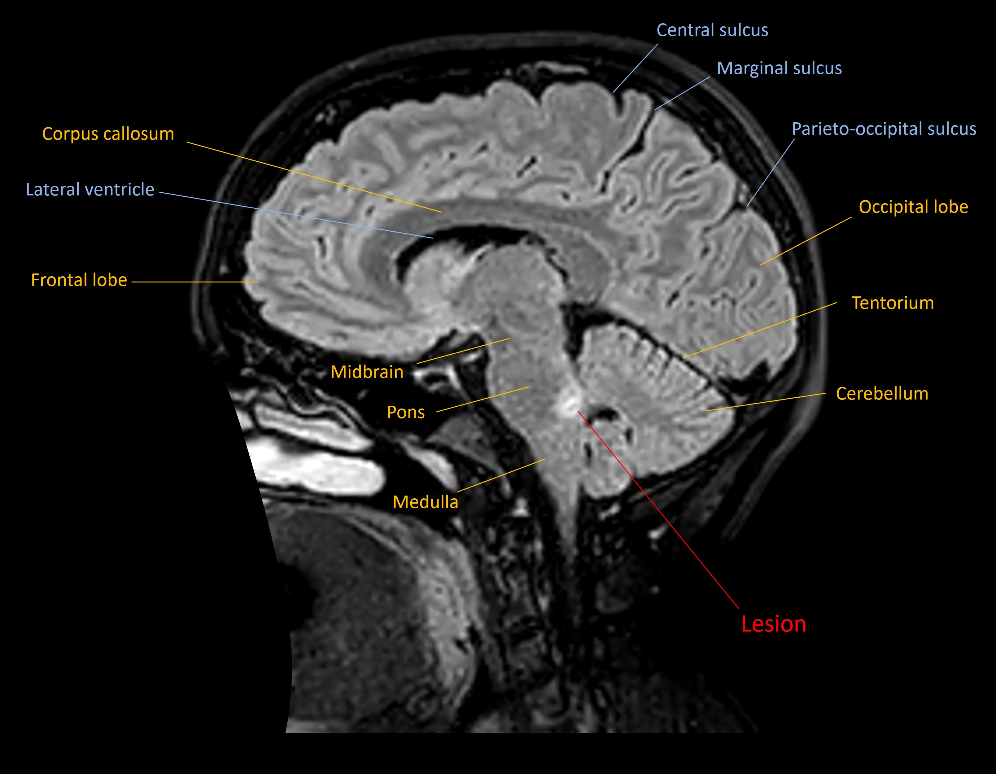 Axial MRI