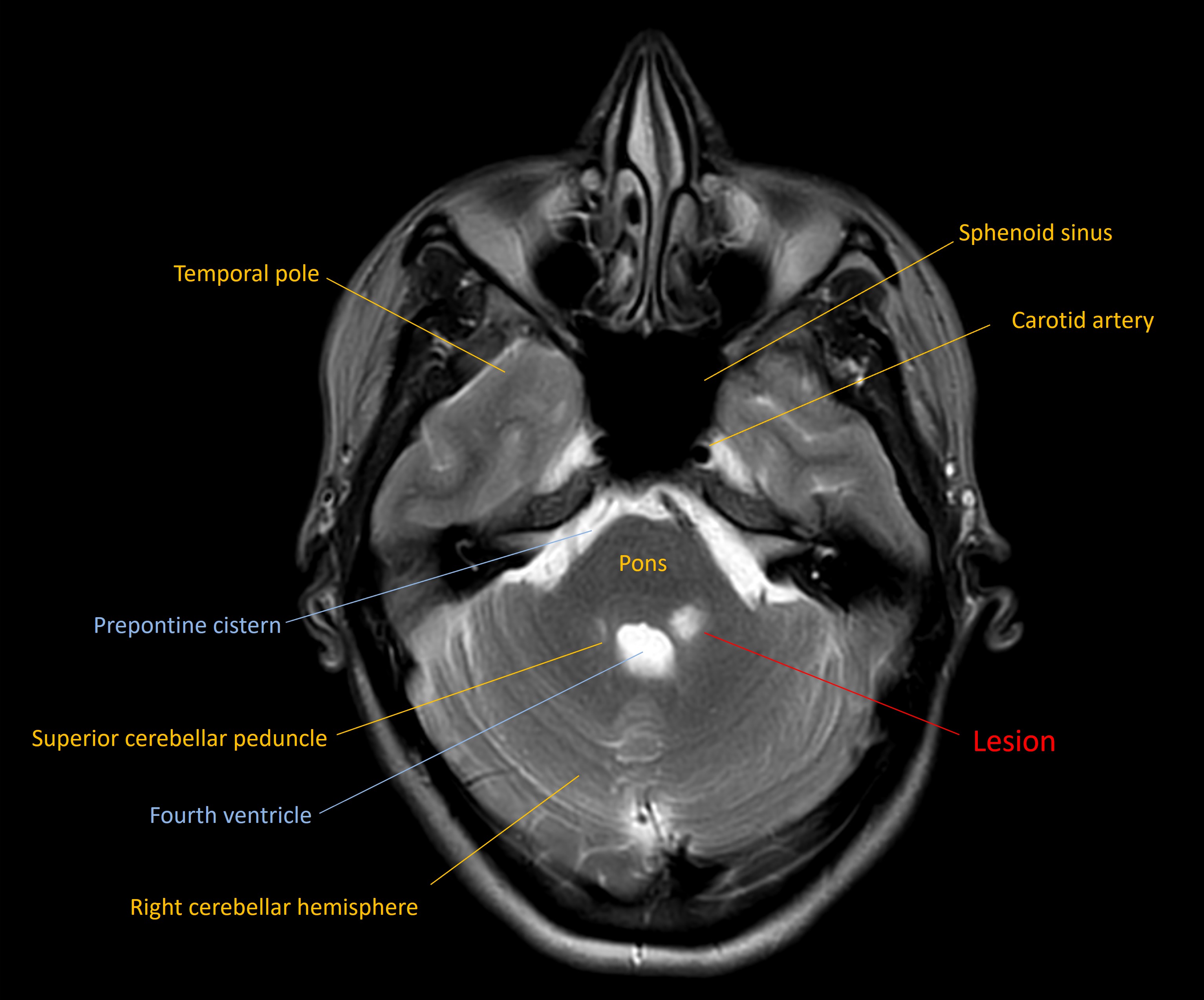 Axial MRI