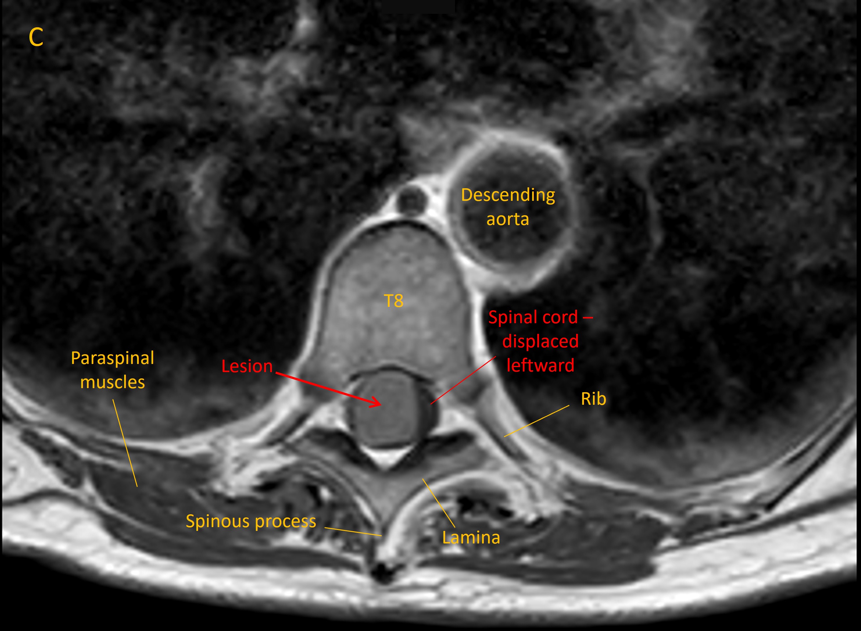 Axial MRI
