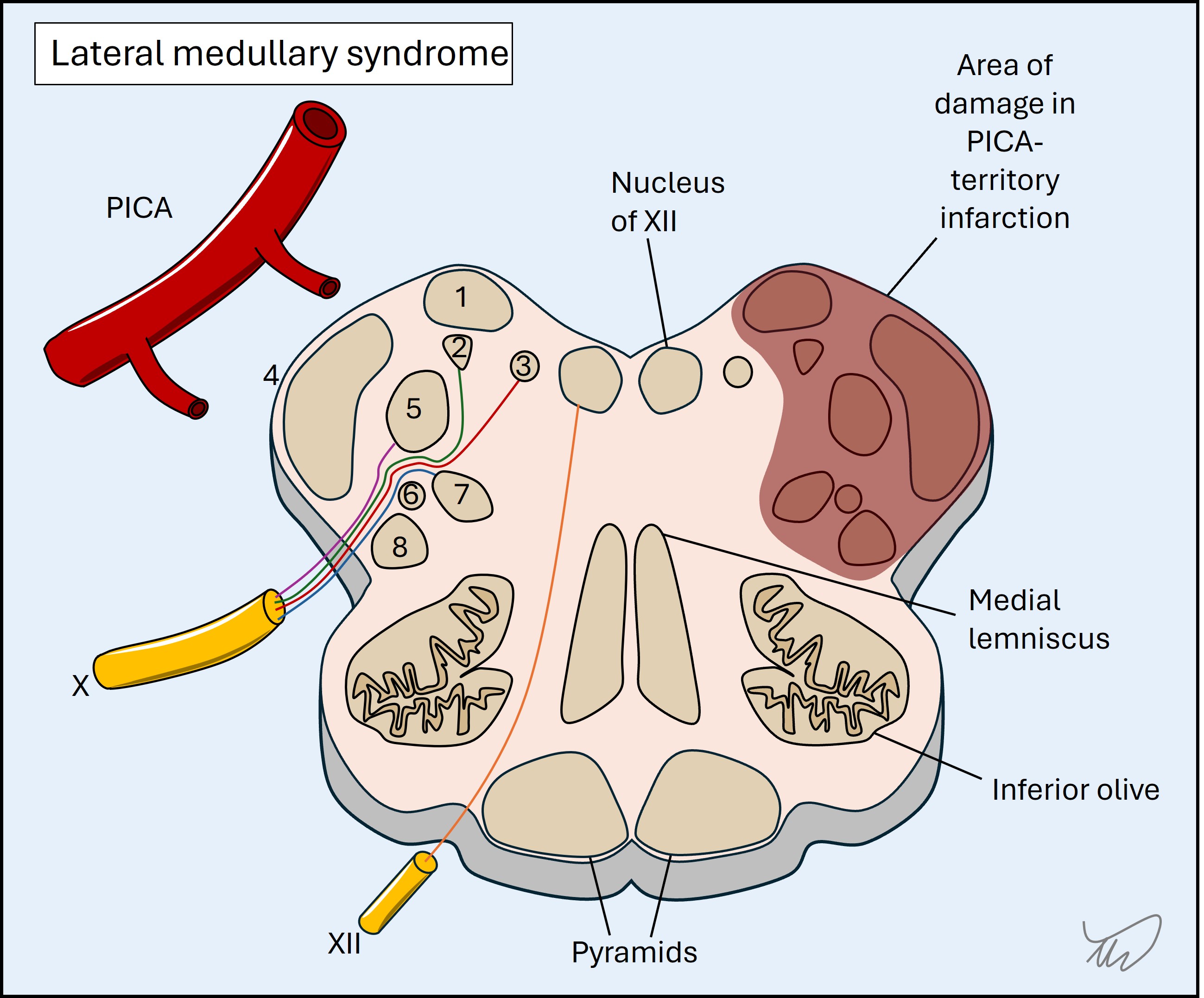 Lateral medullary syndrome