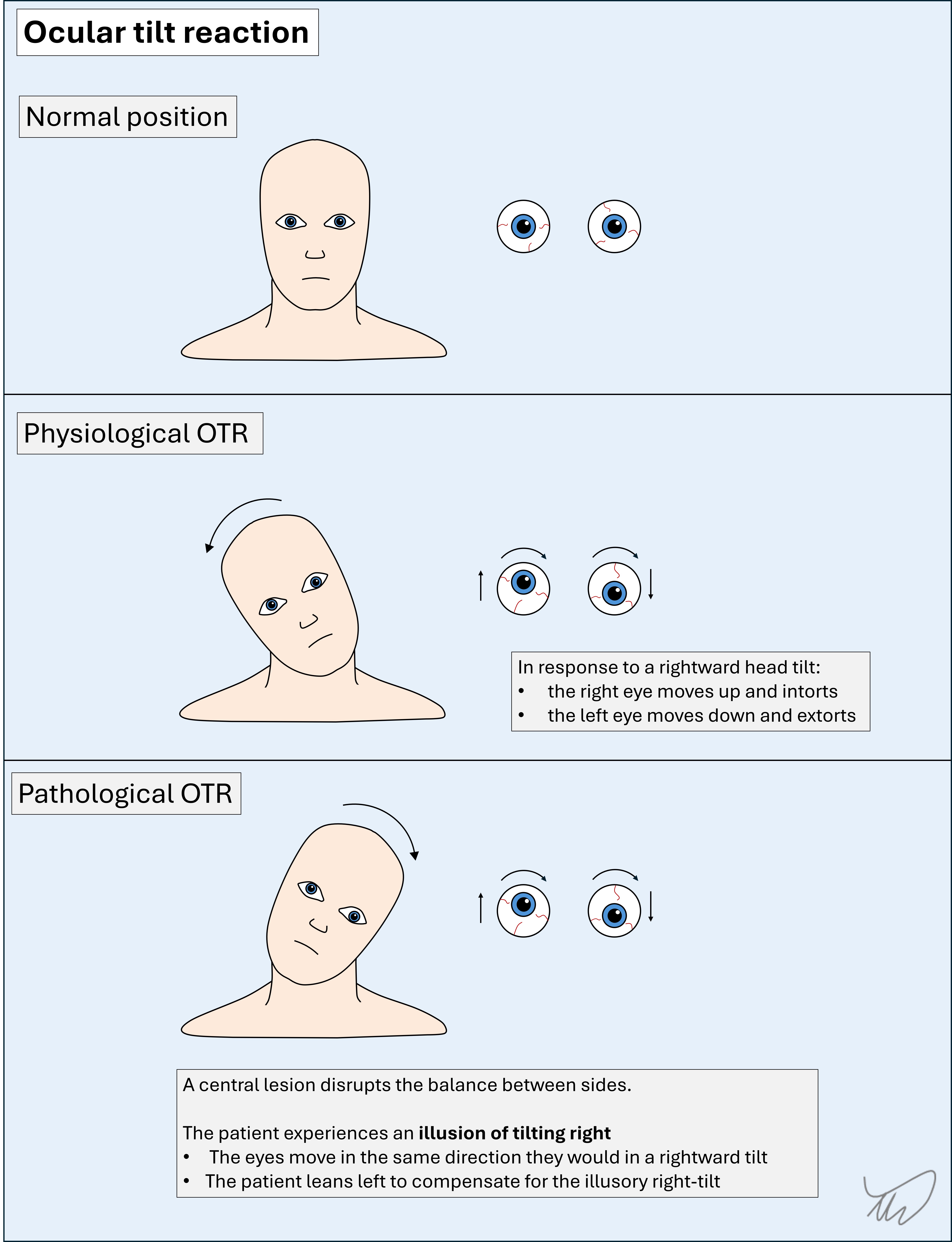 Ocular tilt reaction