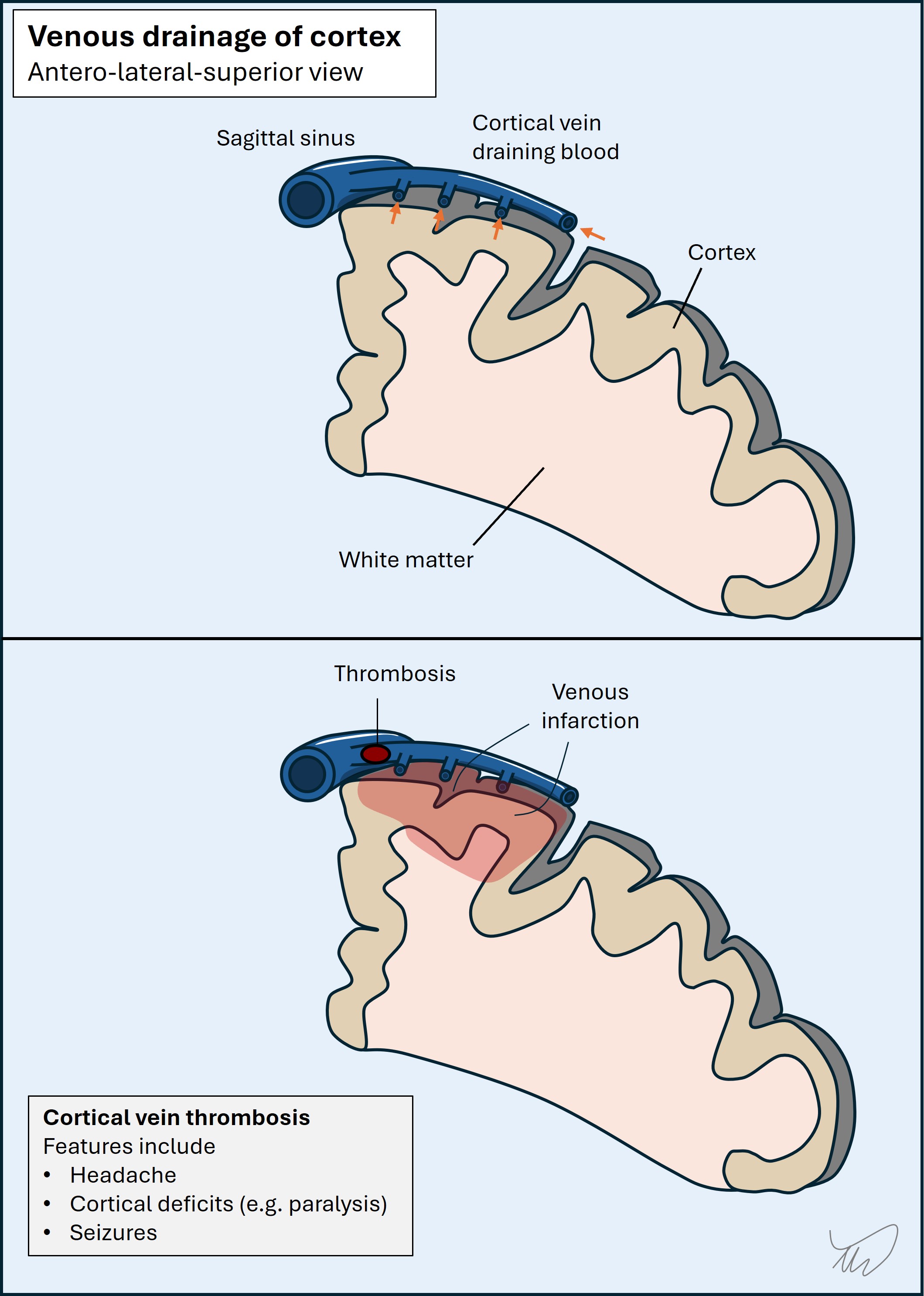 Cortical venous thrombosis
