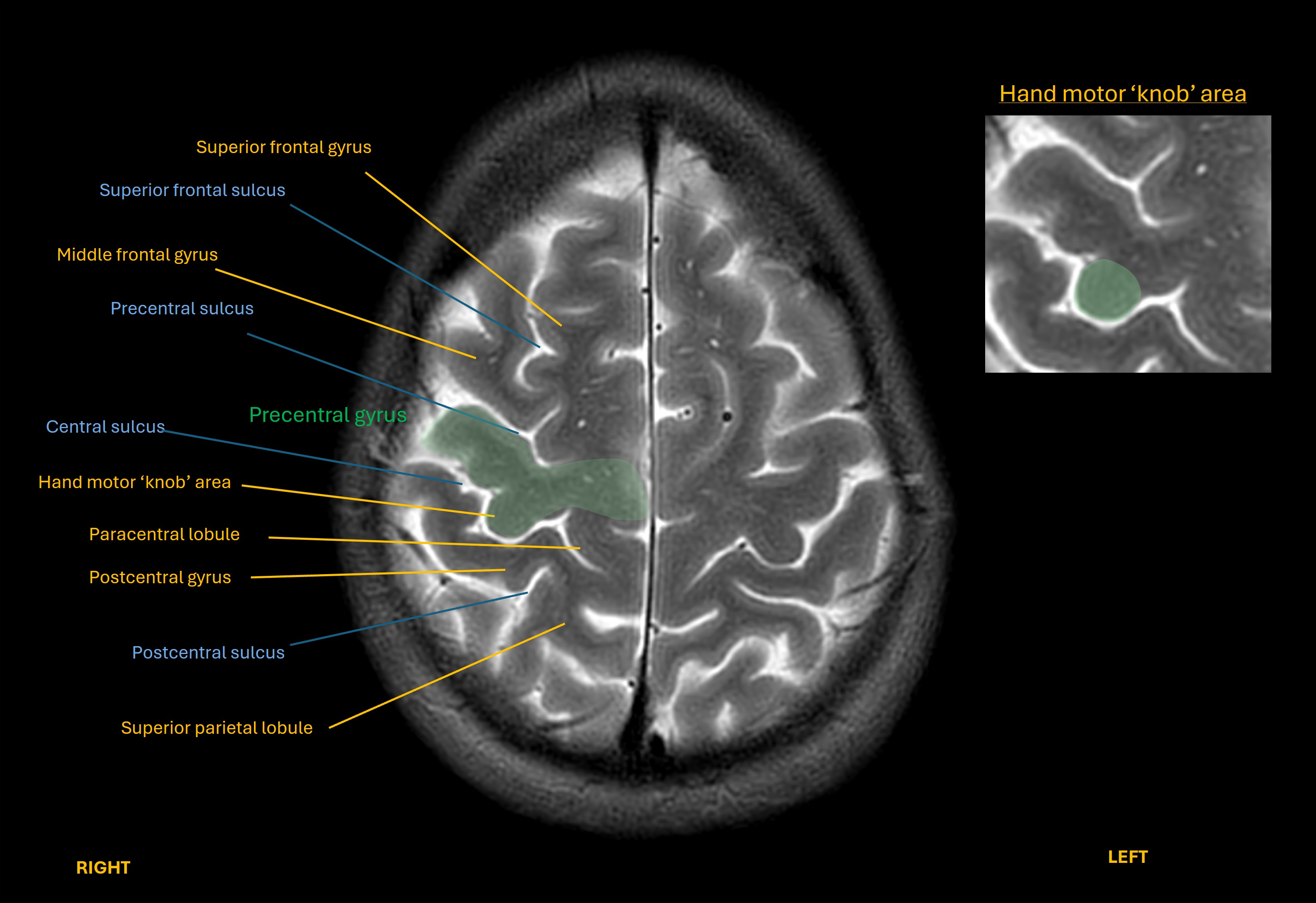 Motor hand knob area