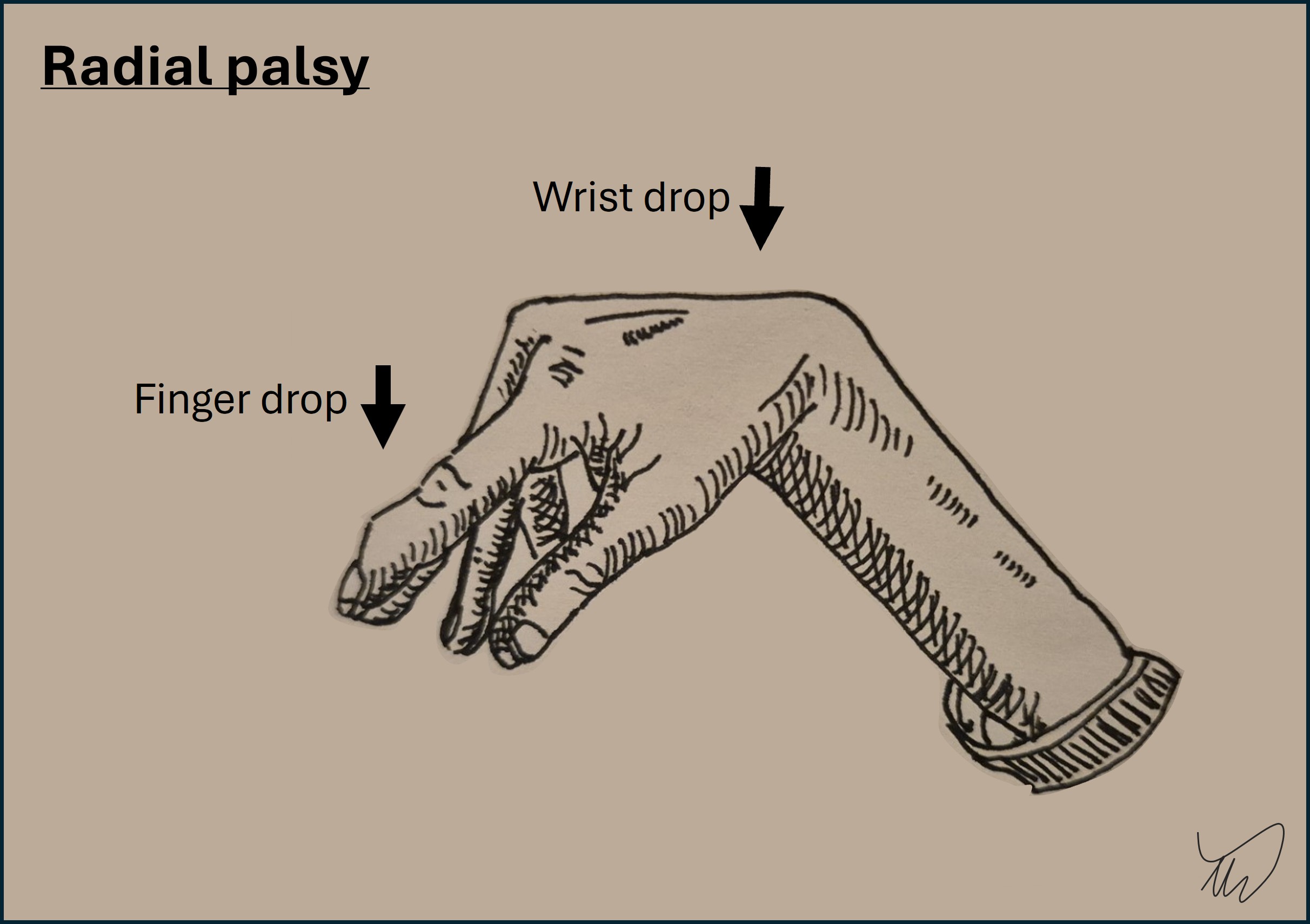 Radial palsy