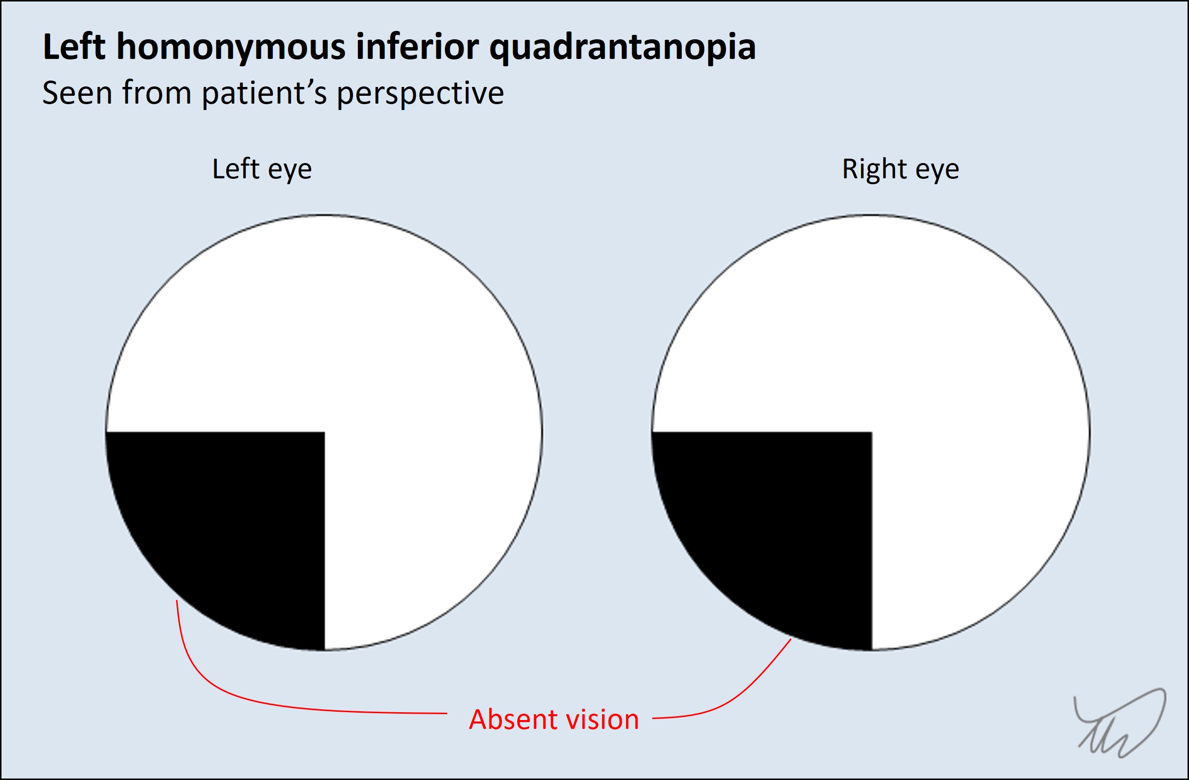 Quadrantanopia