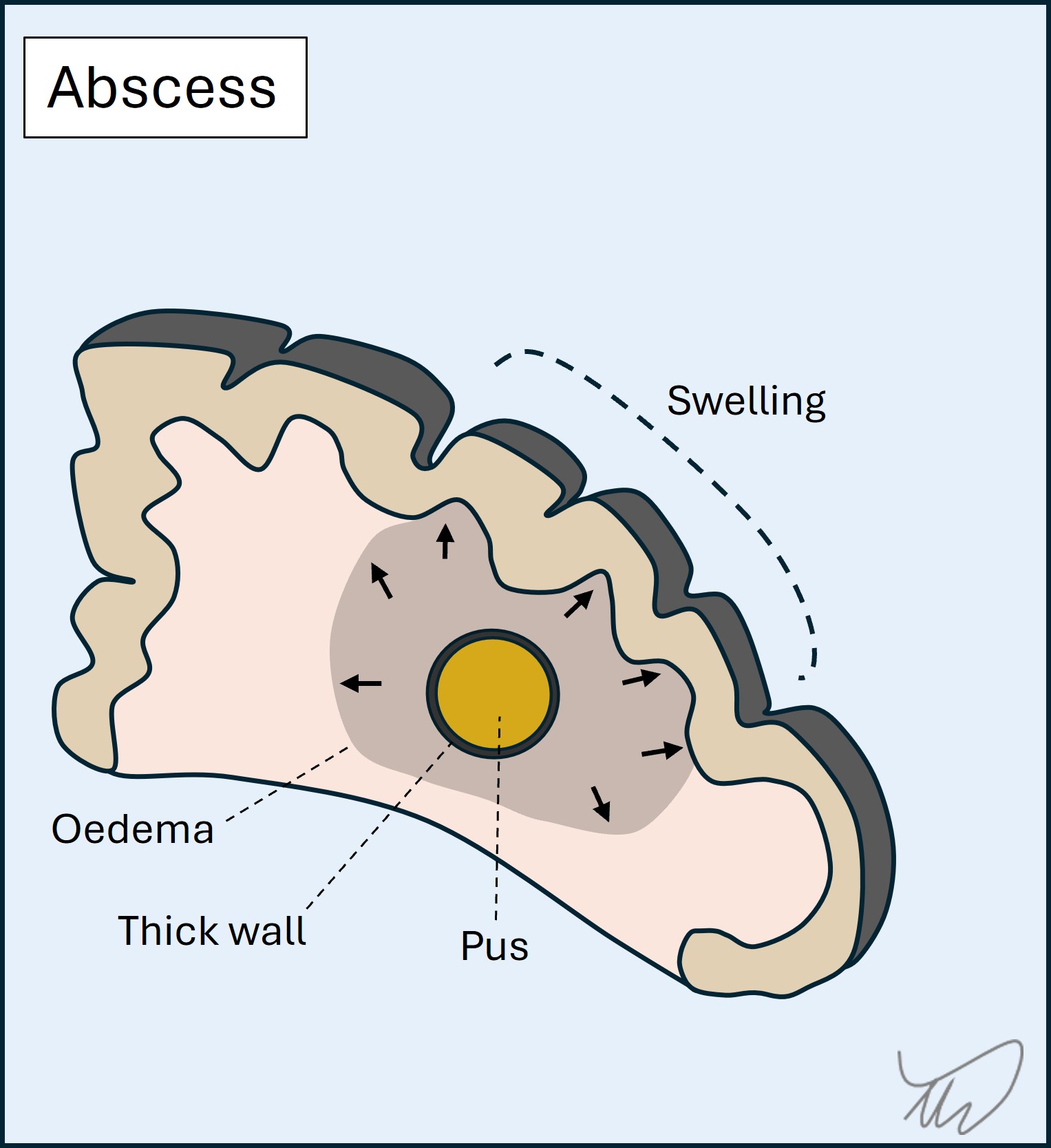 Abscess