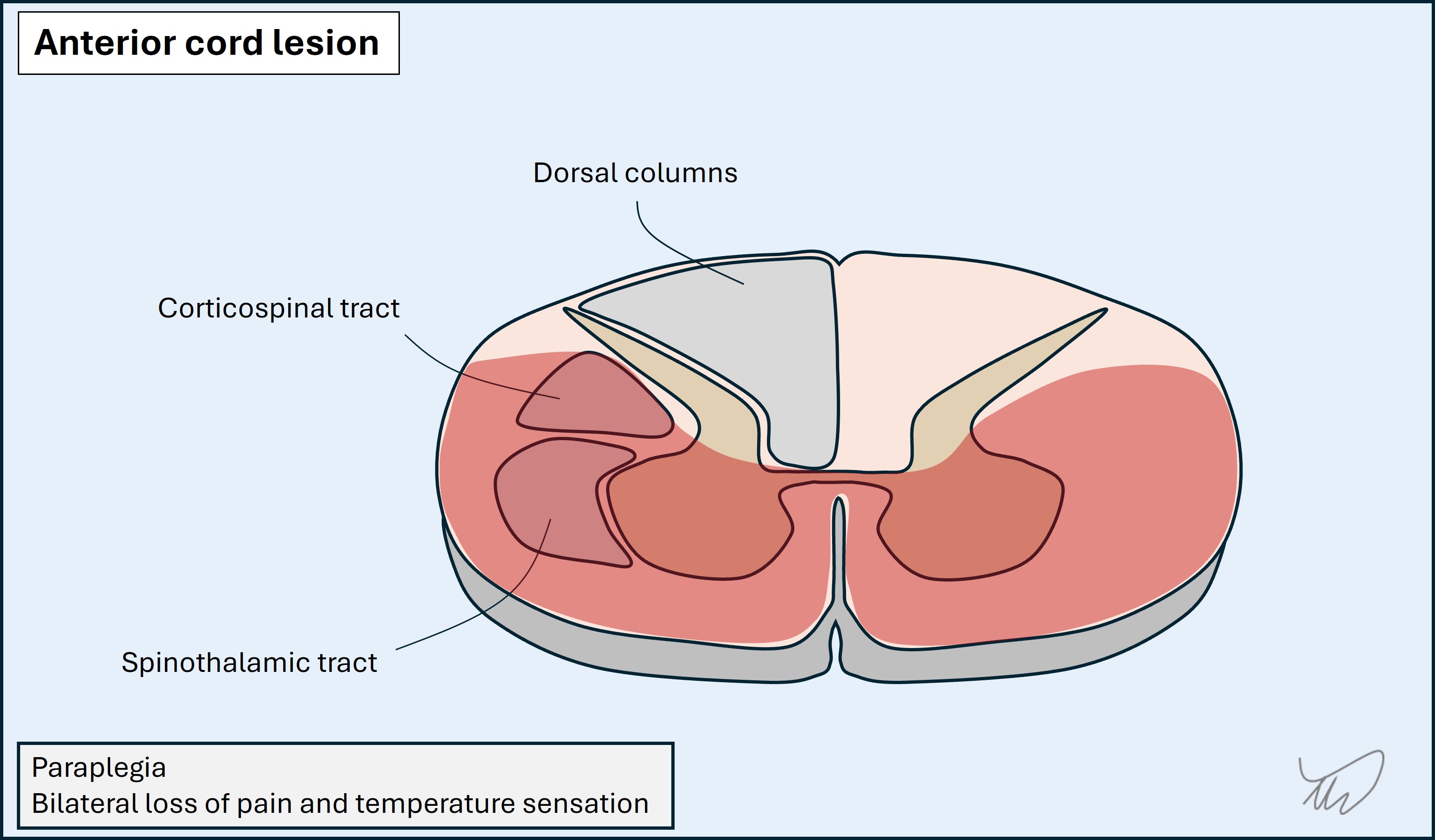 Anterior cord lesion