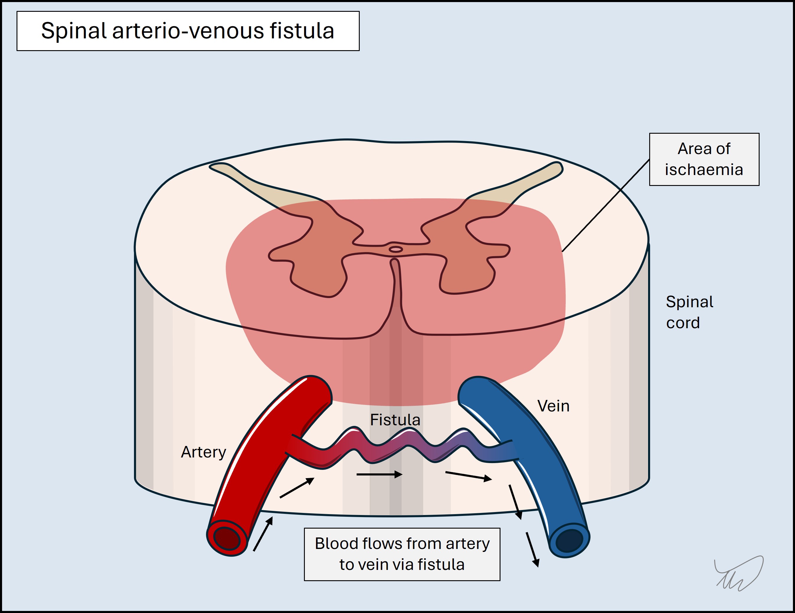 Arteriovenous fistula