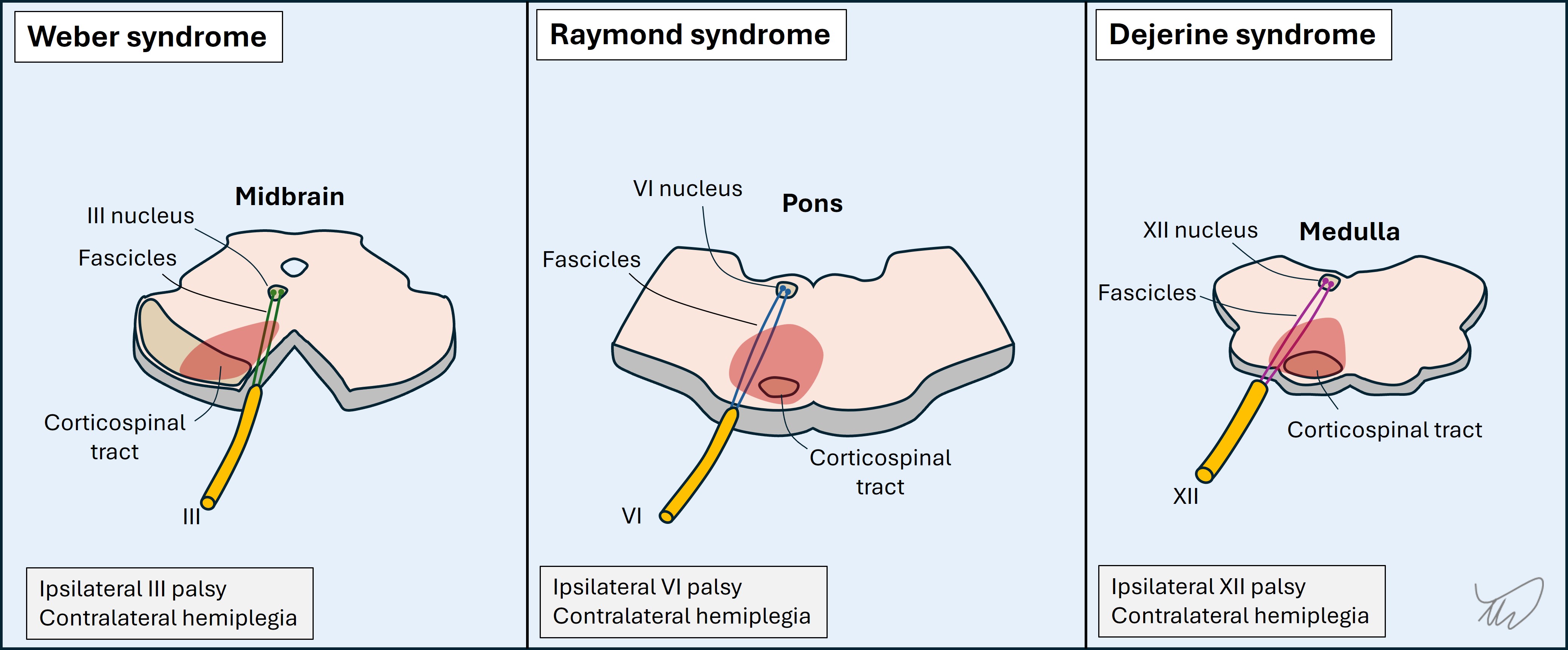 Brainstem eponyms