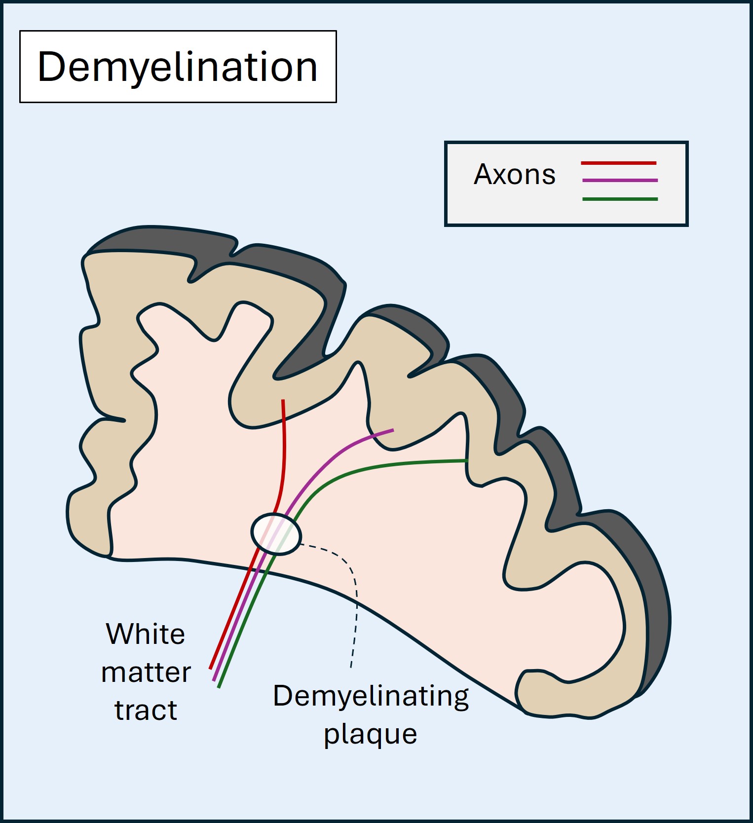 Demyelination