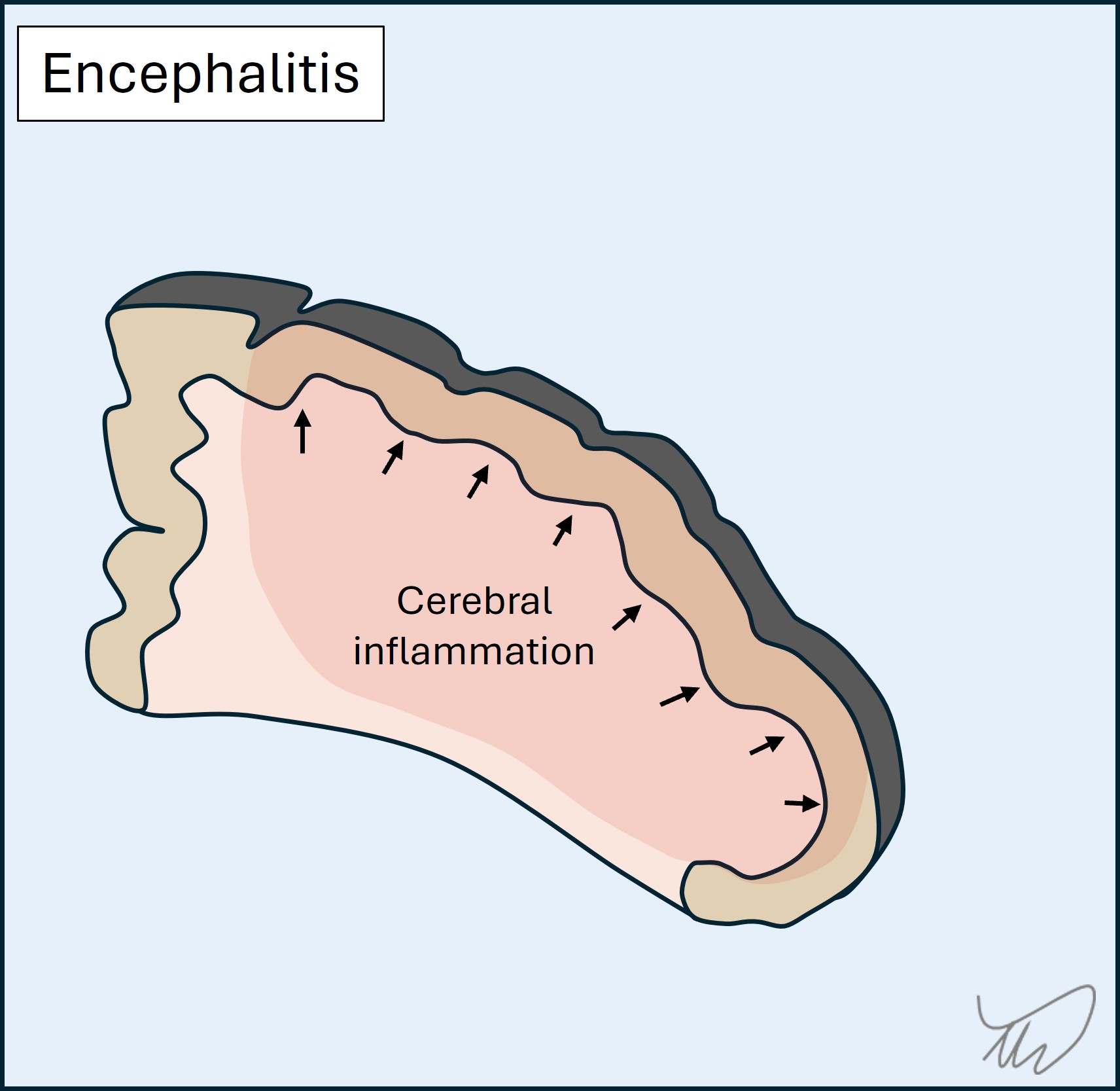 Encephalitis