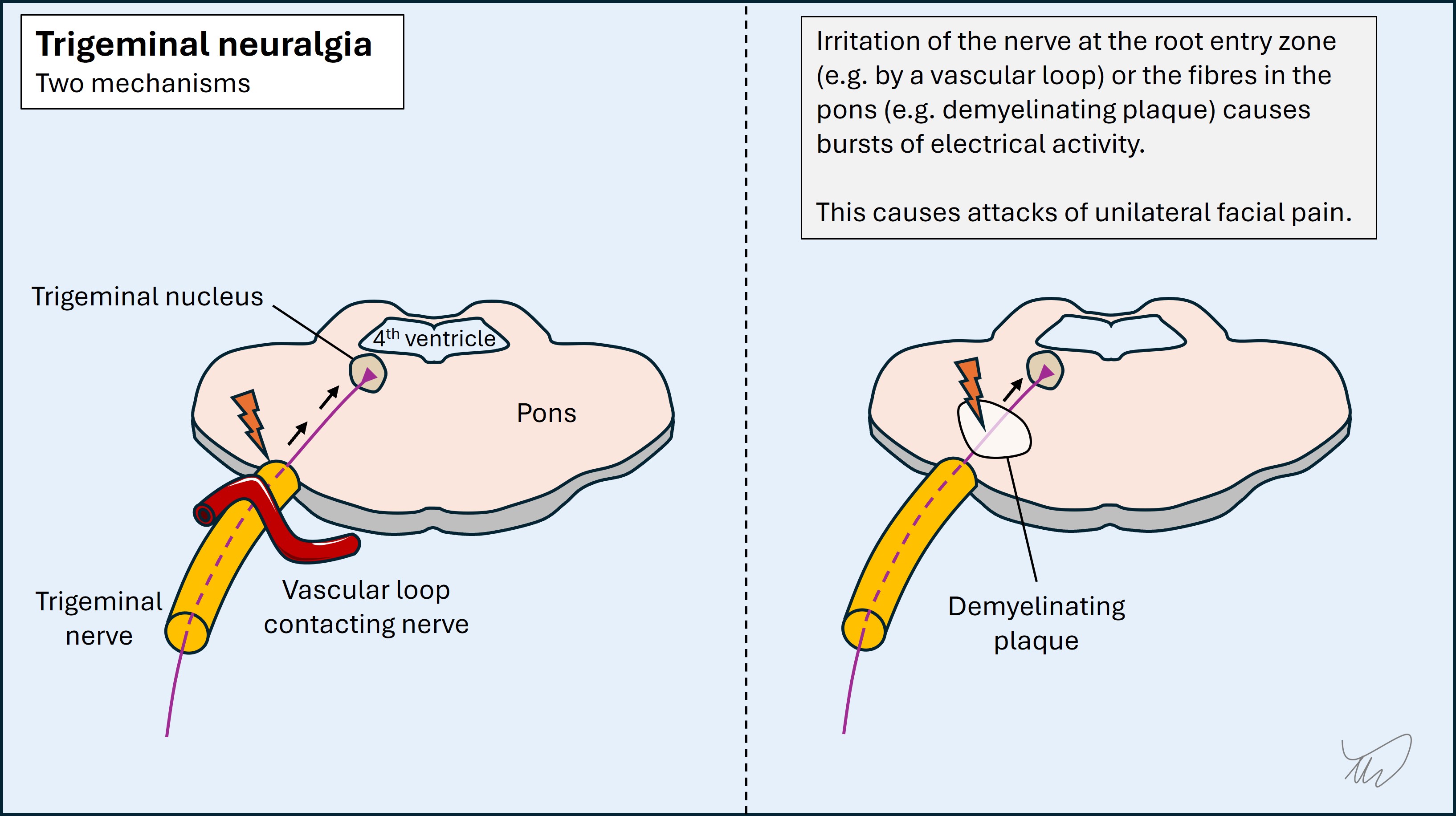 Trigeminal neuralgia