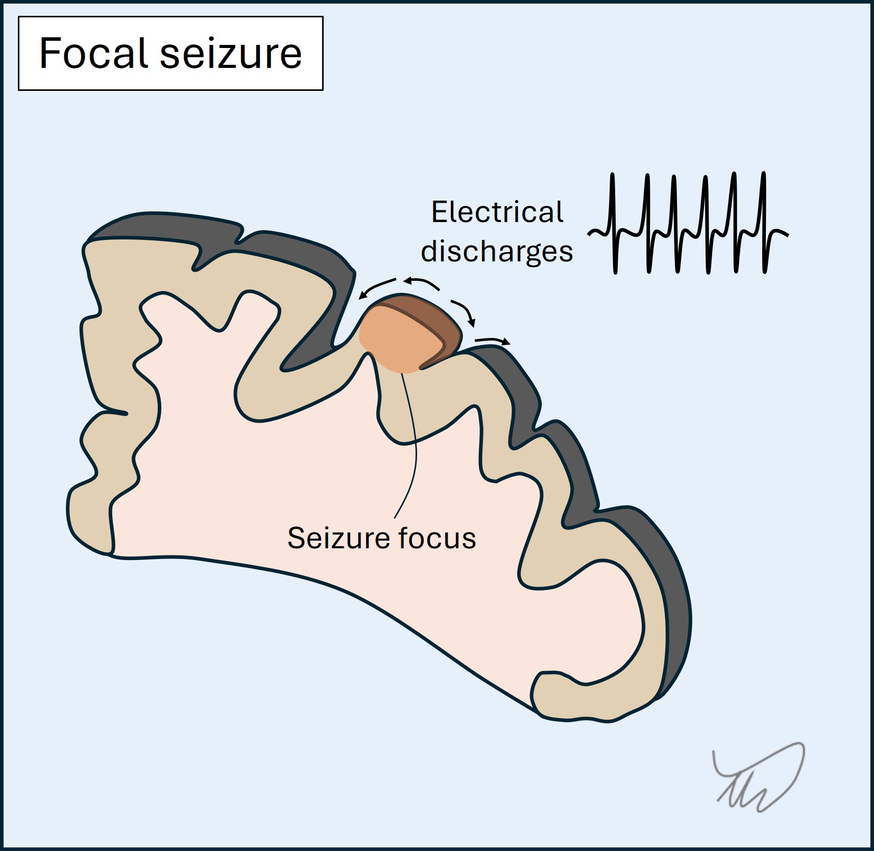 Focal seizure