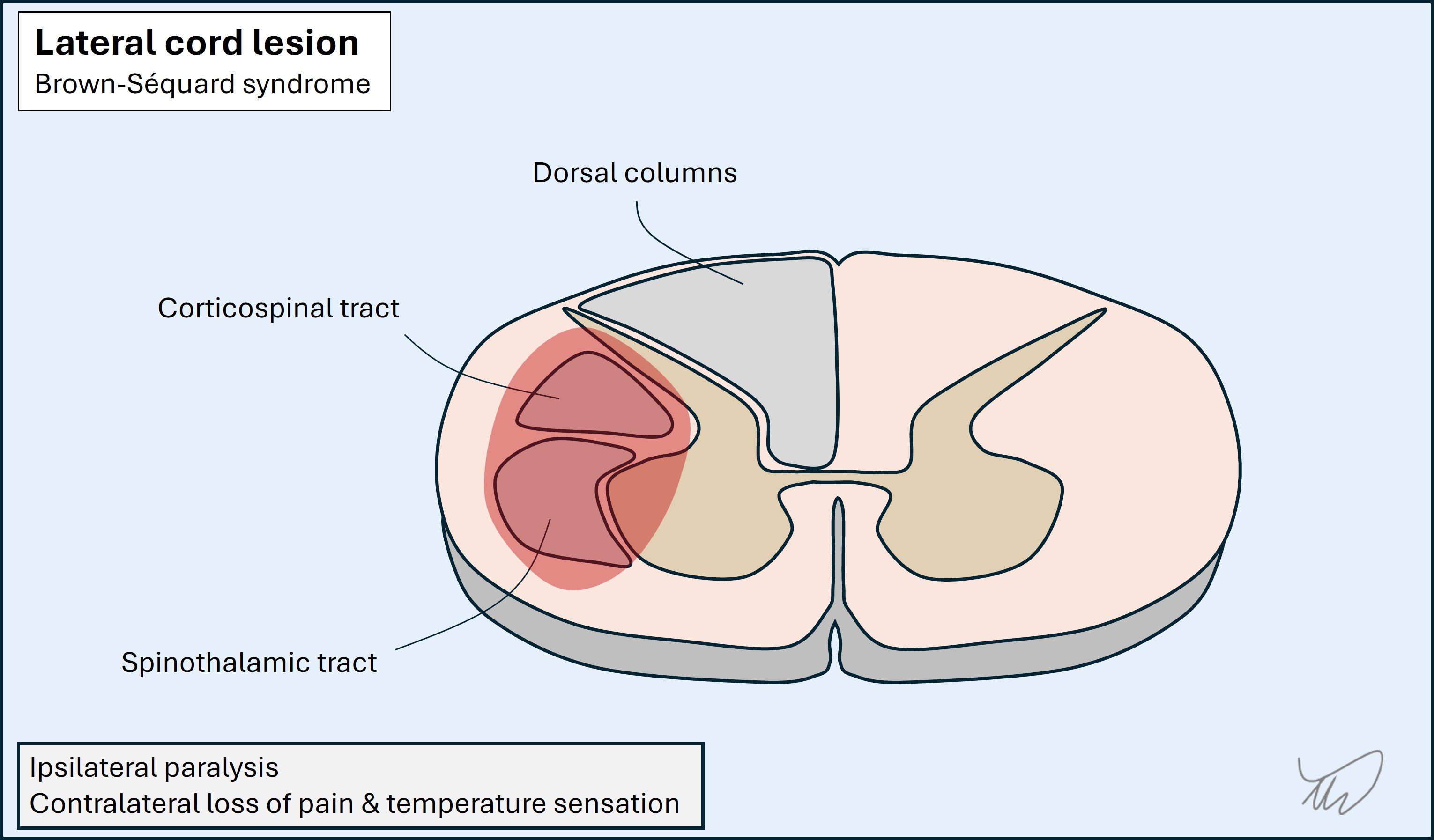 Lateral cord lesion
