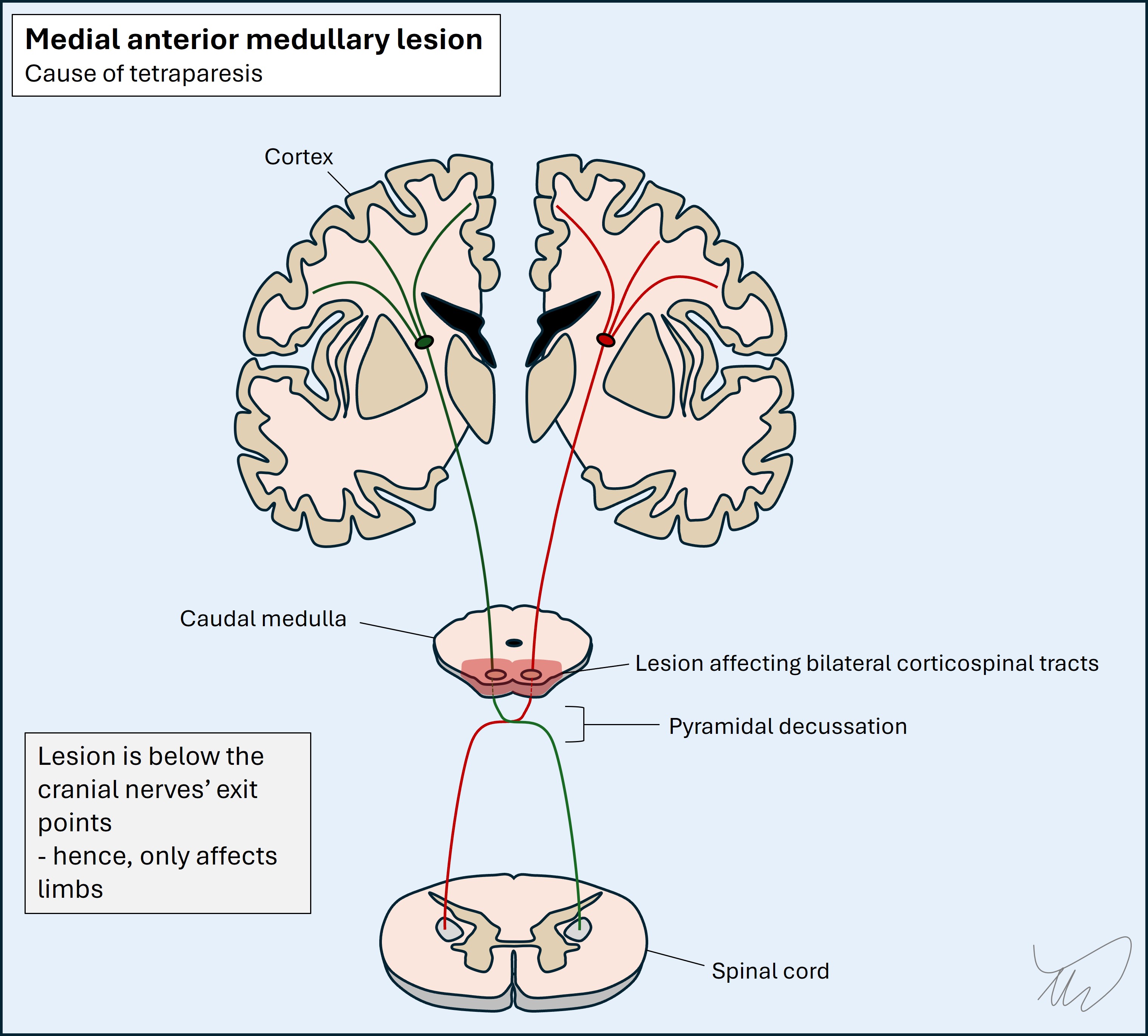 medial medullary lesion