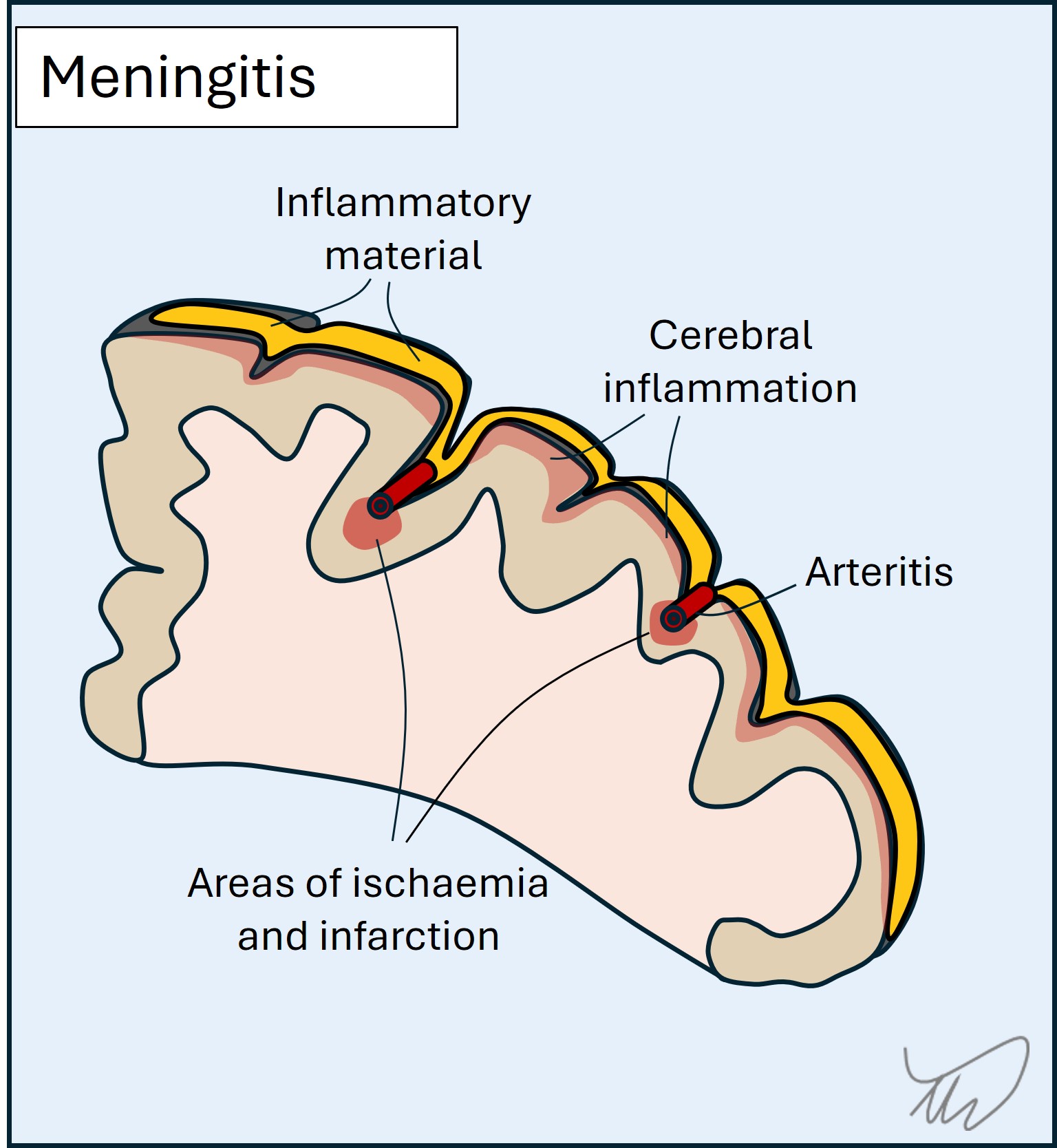 Meningitis