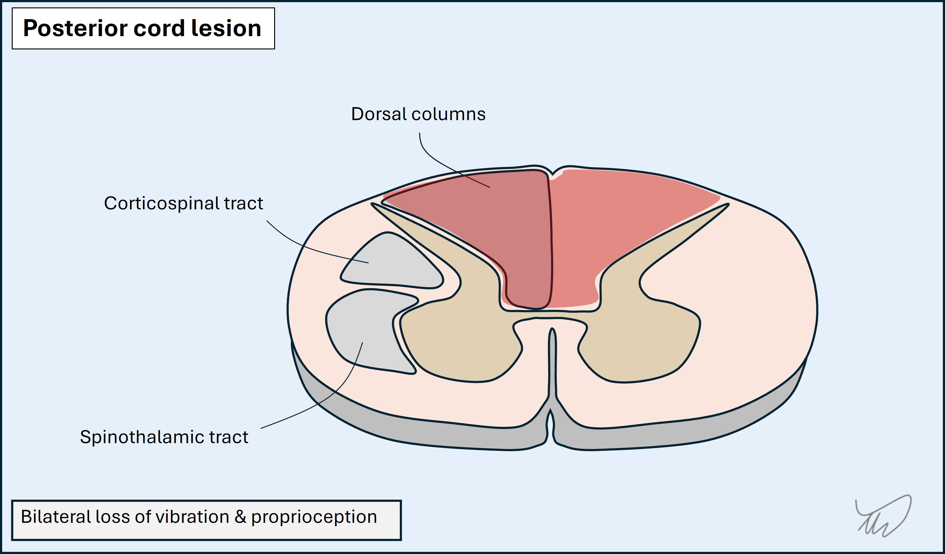 Posterior cord lesion