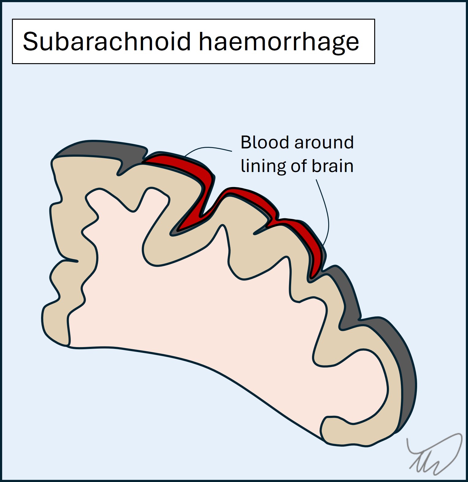 Subarachnoid haemorrhage