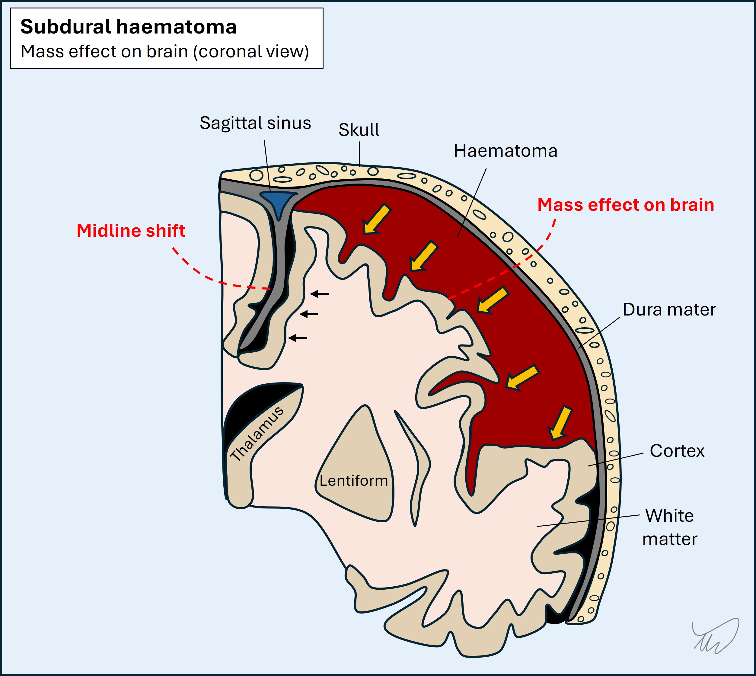 Subdural haemorrhage